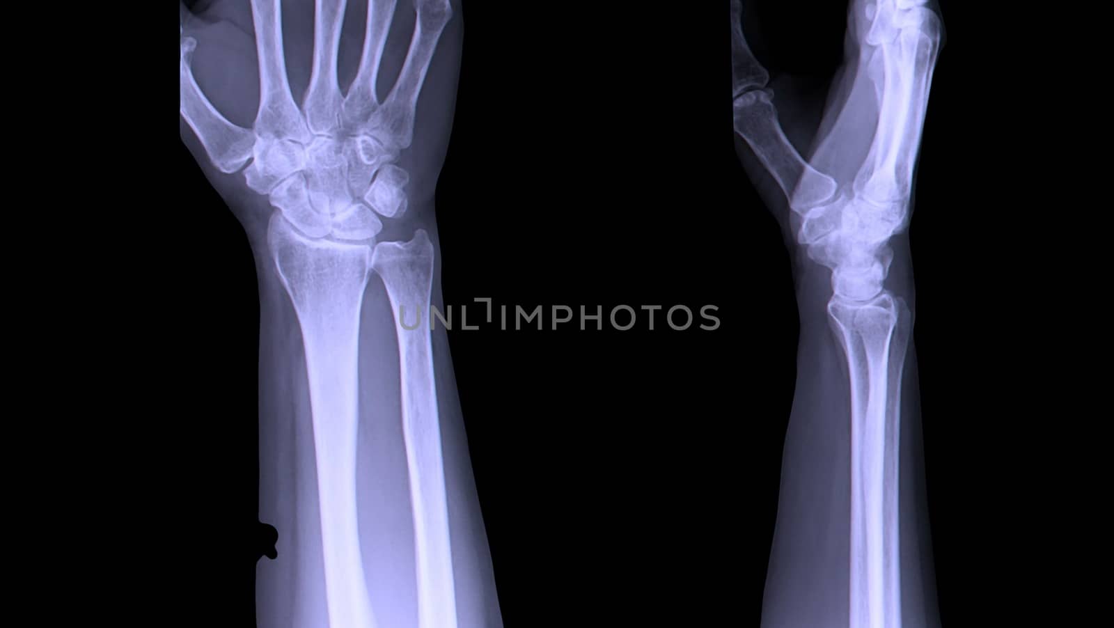 X-ray hand