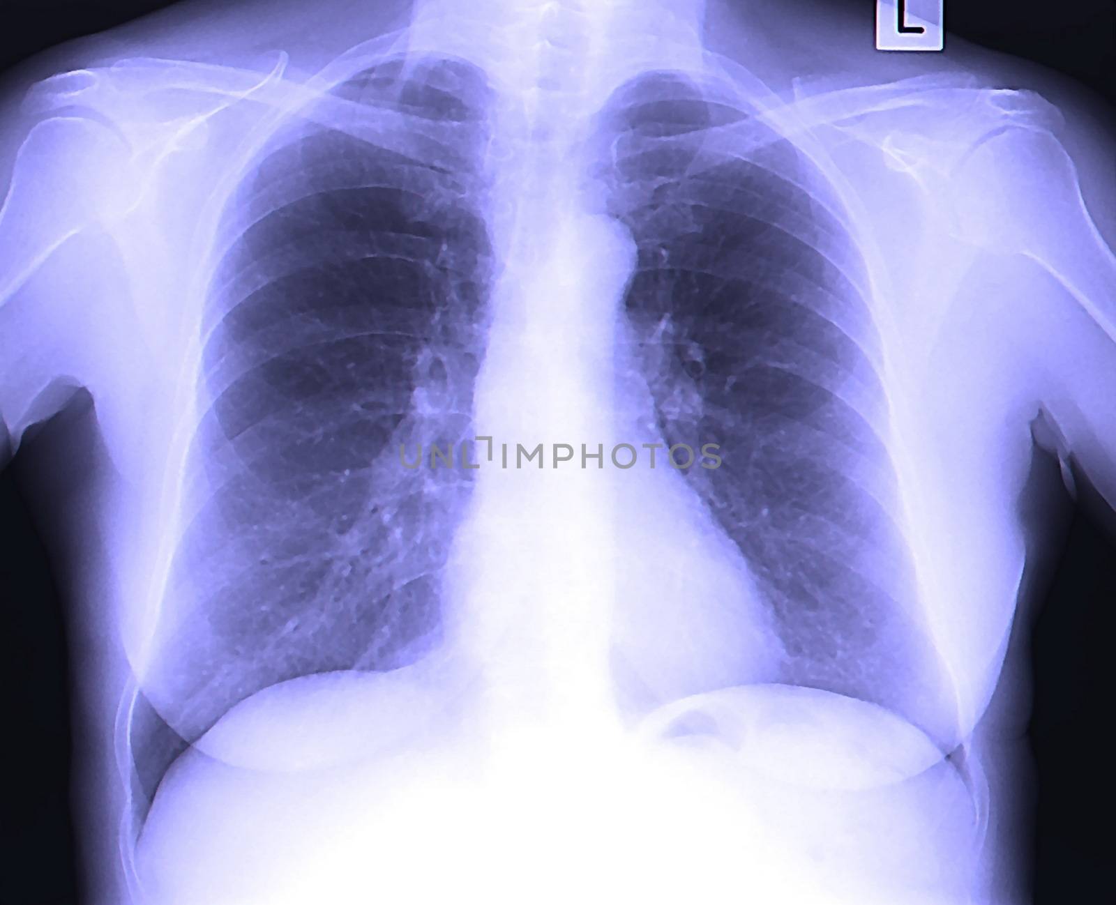 A chest x-ray image for a medical diagnosis