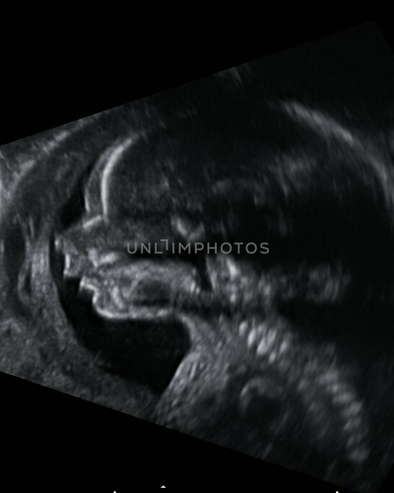 ultrasound fetus