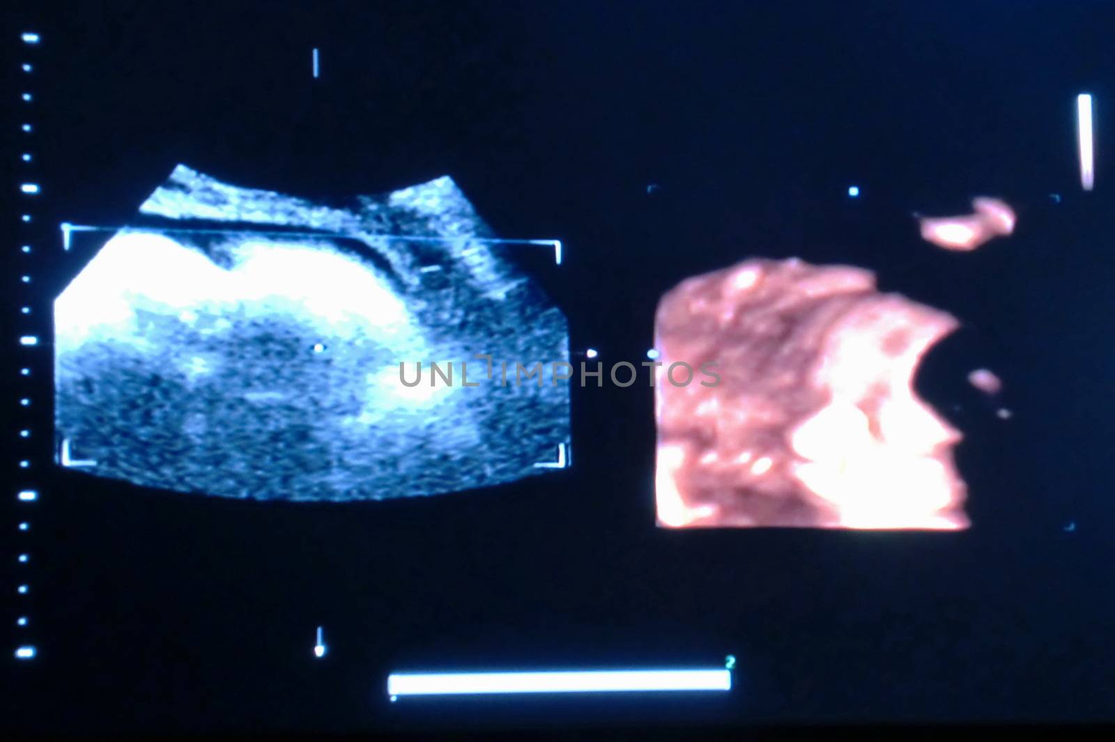 ultrasound fetus