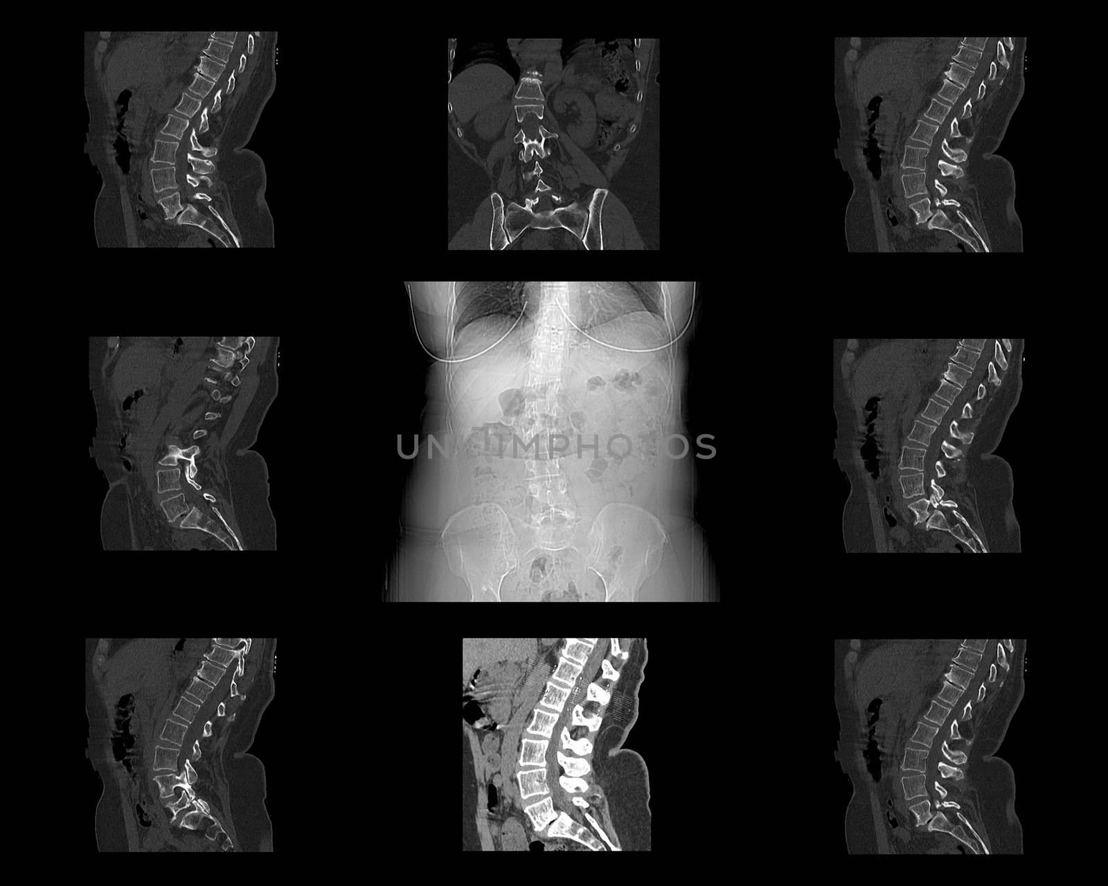 Computed Tomography of lumbar spine, lower back