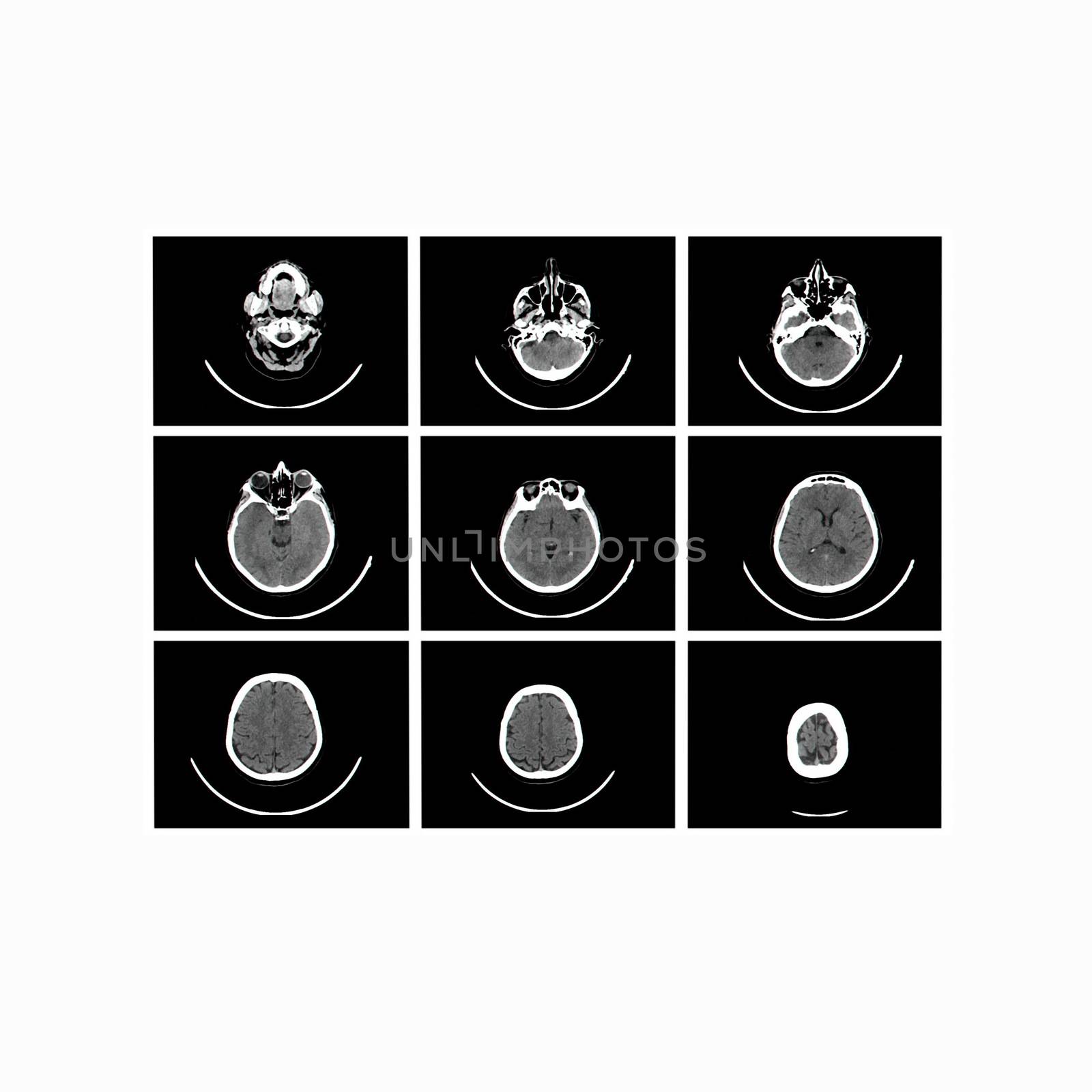 X-ray image of the brain computed tomography