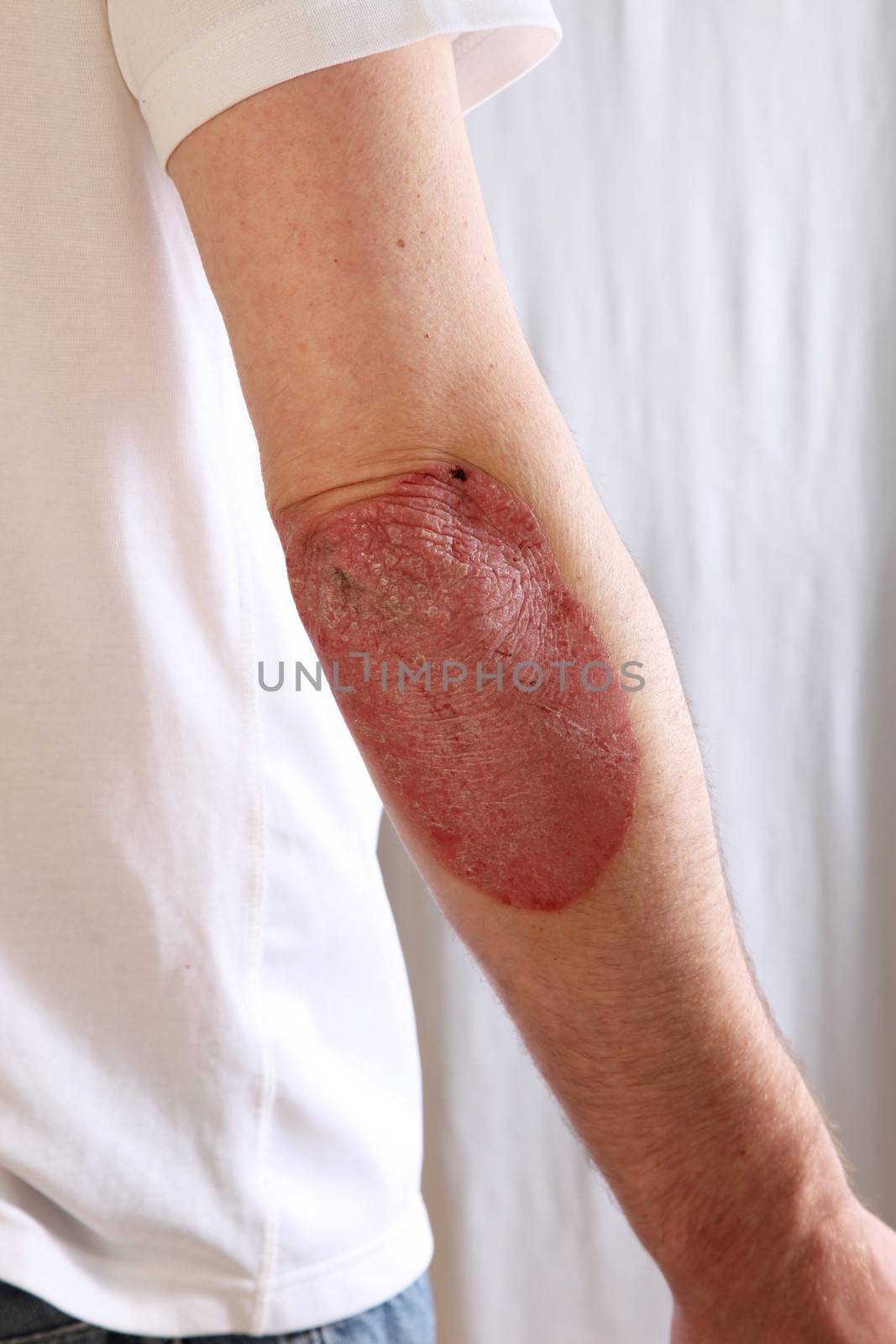 Person suffering from psoriasis with a large inflamed patch of red skin extending from the elbow covered in silvery scales , also known as plaque psoriasis