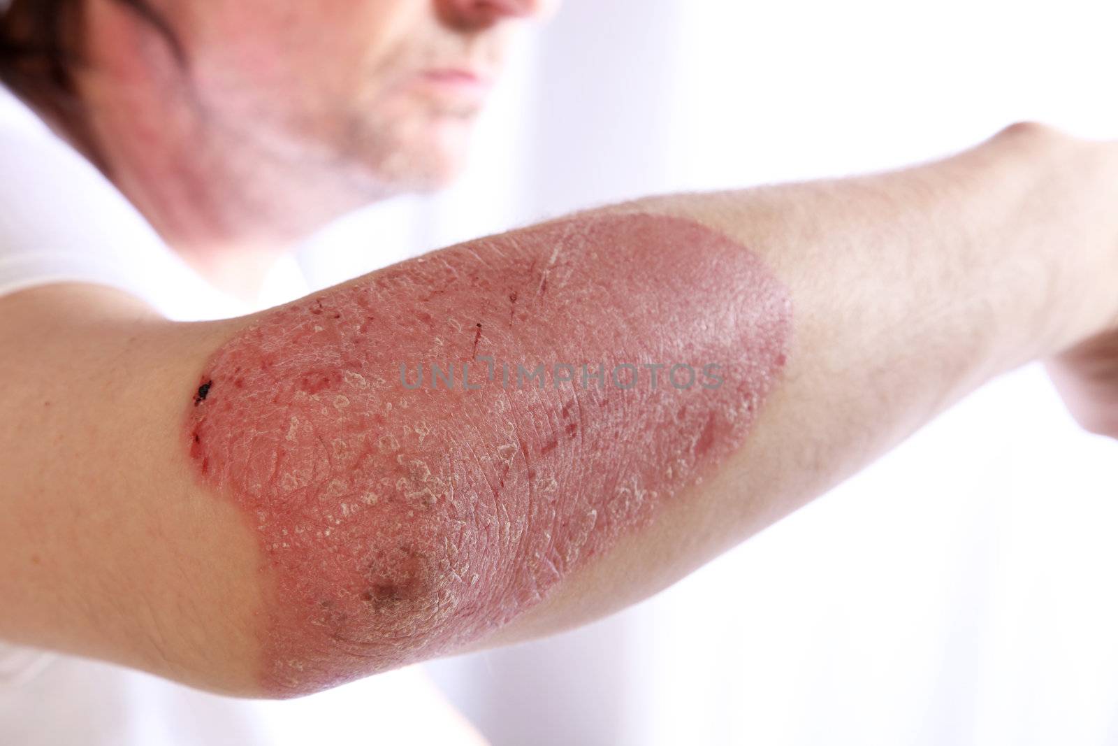 Person with plaque psoriasis of the arm causing an inflamed red patch of skin covered in silvery scales to extend from the elbow, a chronic lifelong disease that is incurable but non-contagious