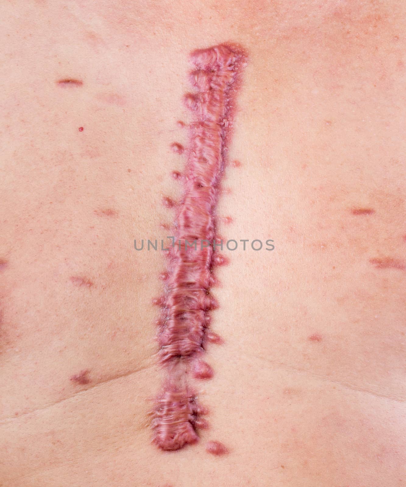 big swell cicatrix - hypertrophic scar