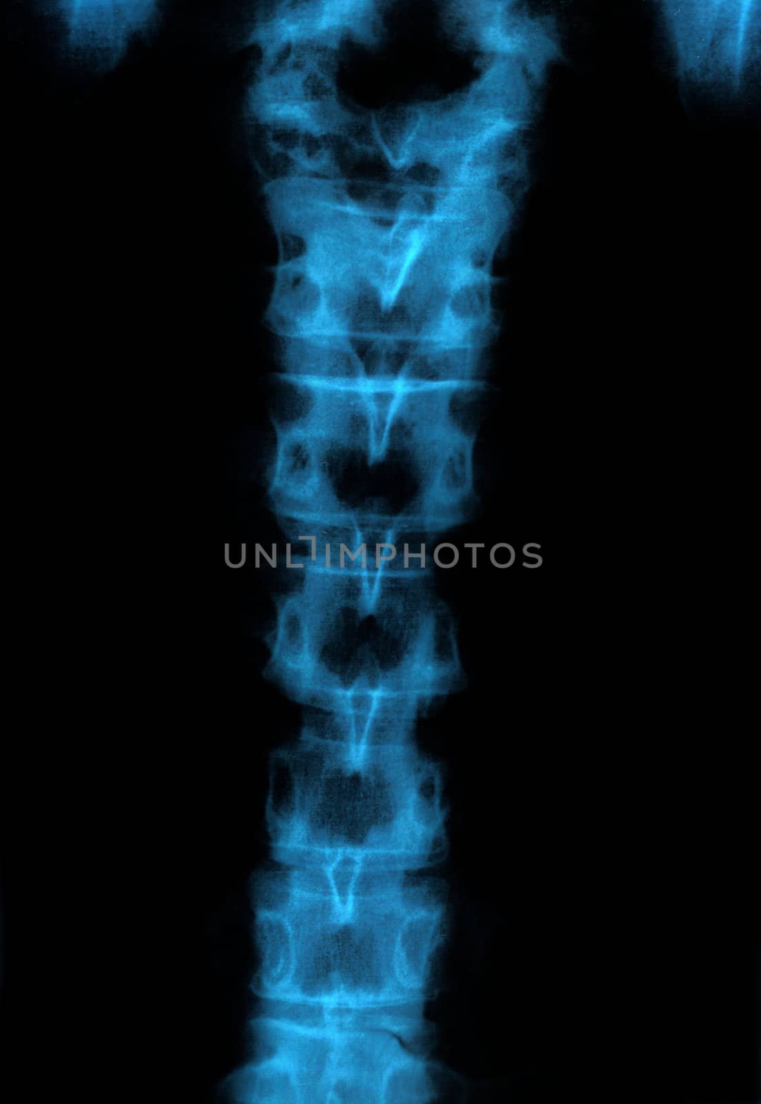 Diagnostic x-ray of injured human spine bones.