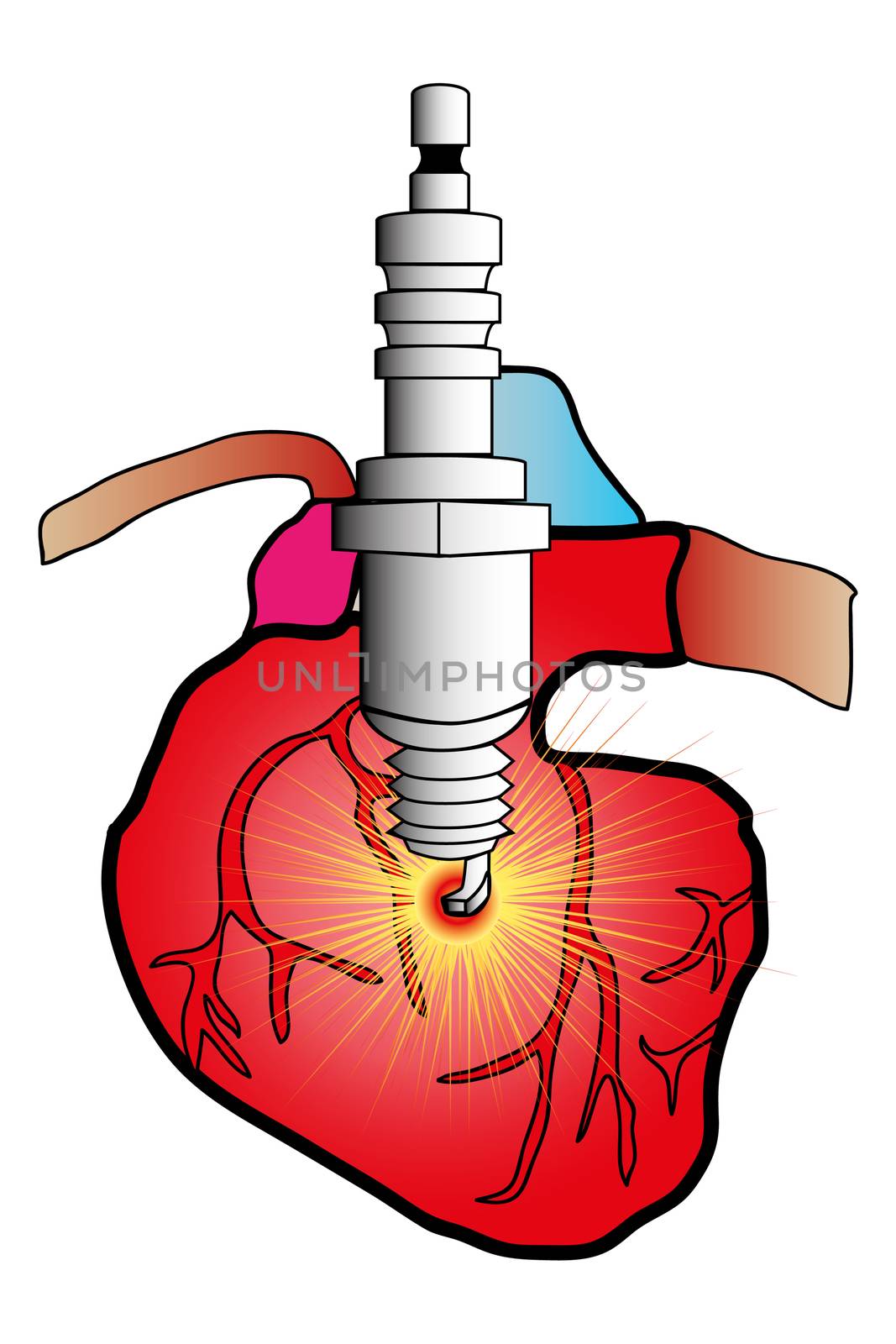 illustration of a heart in cardiovascular surgery cut with a spark plug as defibrillator