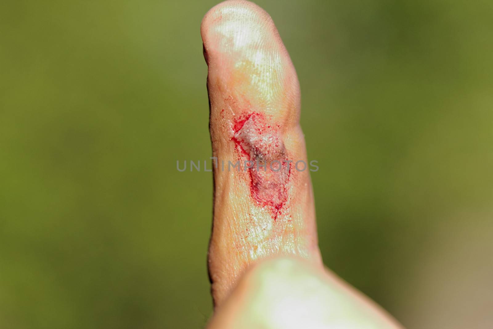 wound on male finger by NagyDodo