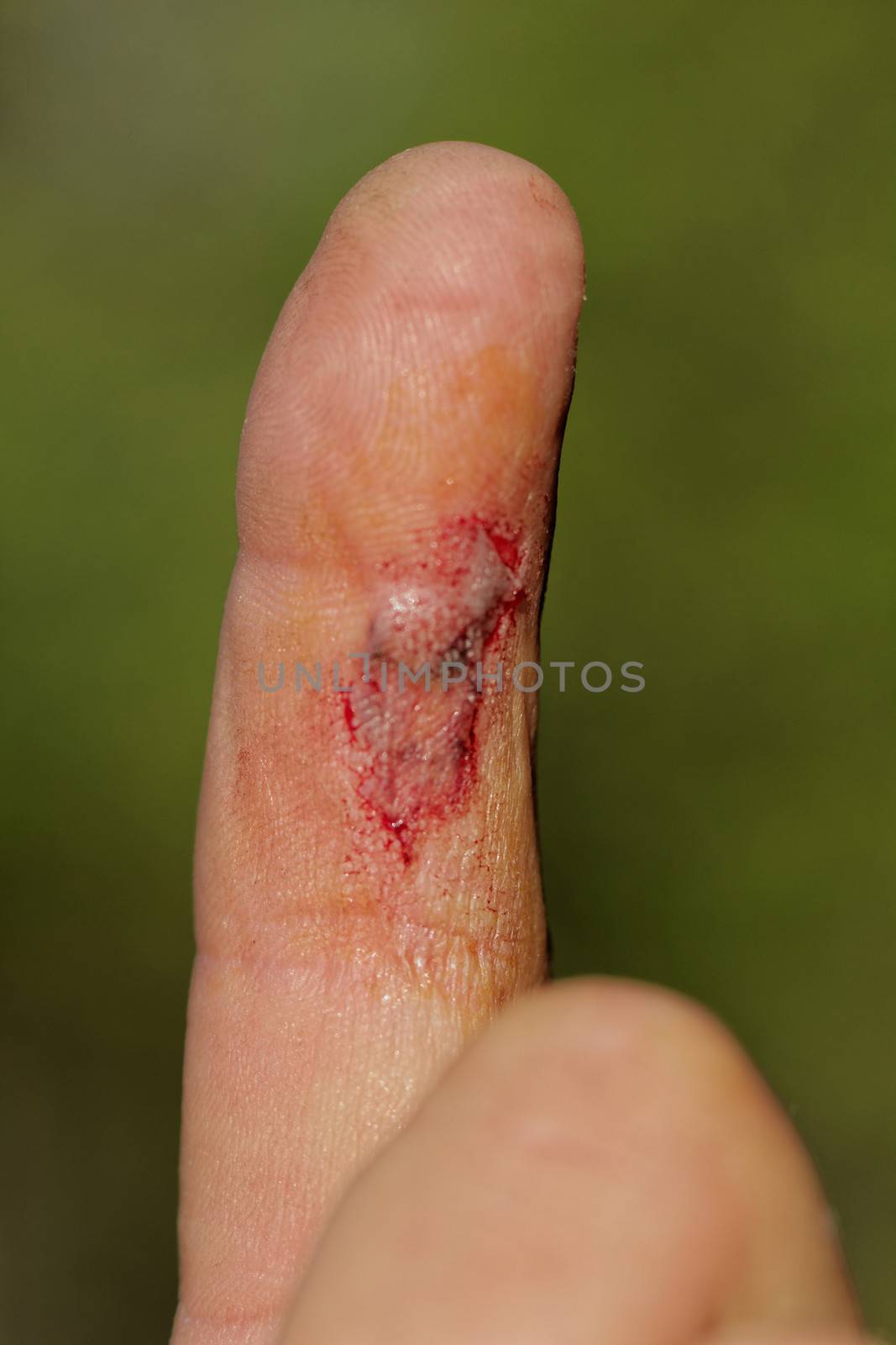 Flesh wound with blood on male finger