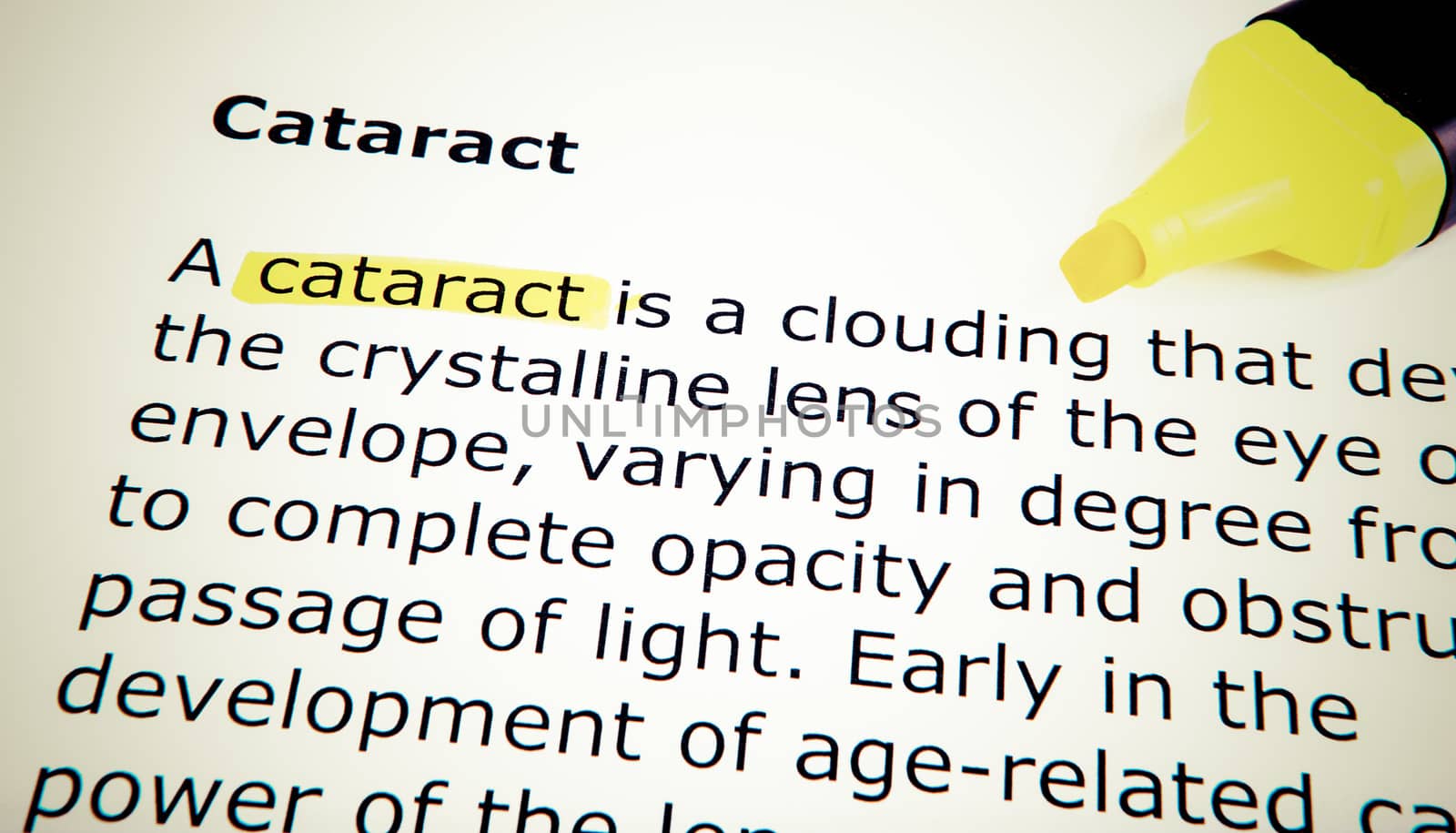 Cataract