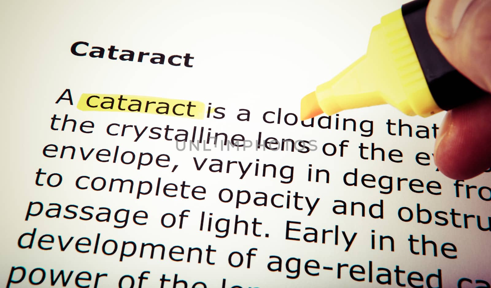 Cataract