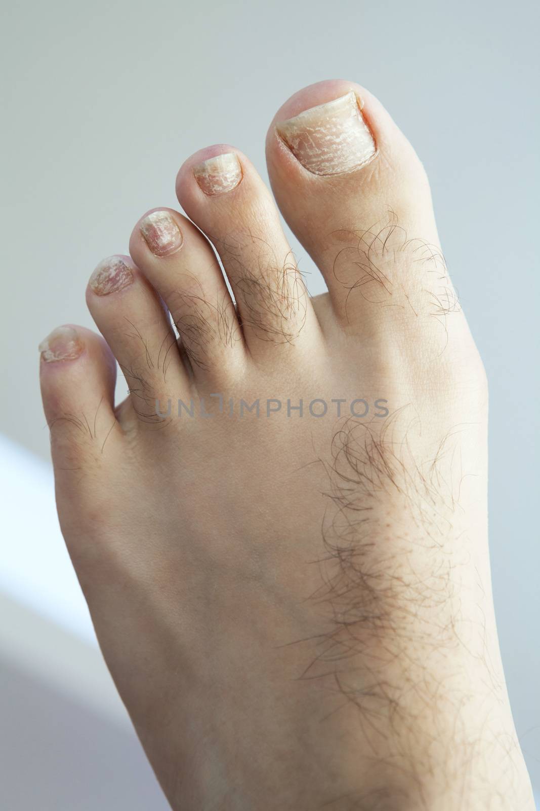 Closeup of a human foot and toes with cracked and peeling toe nails.