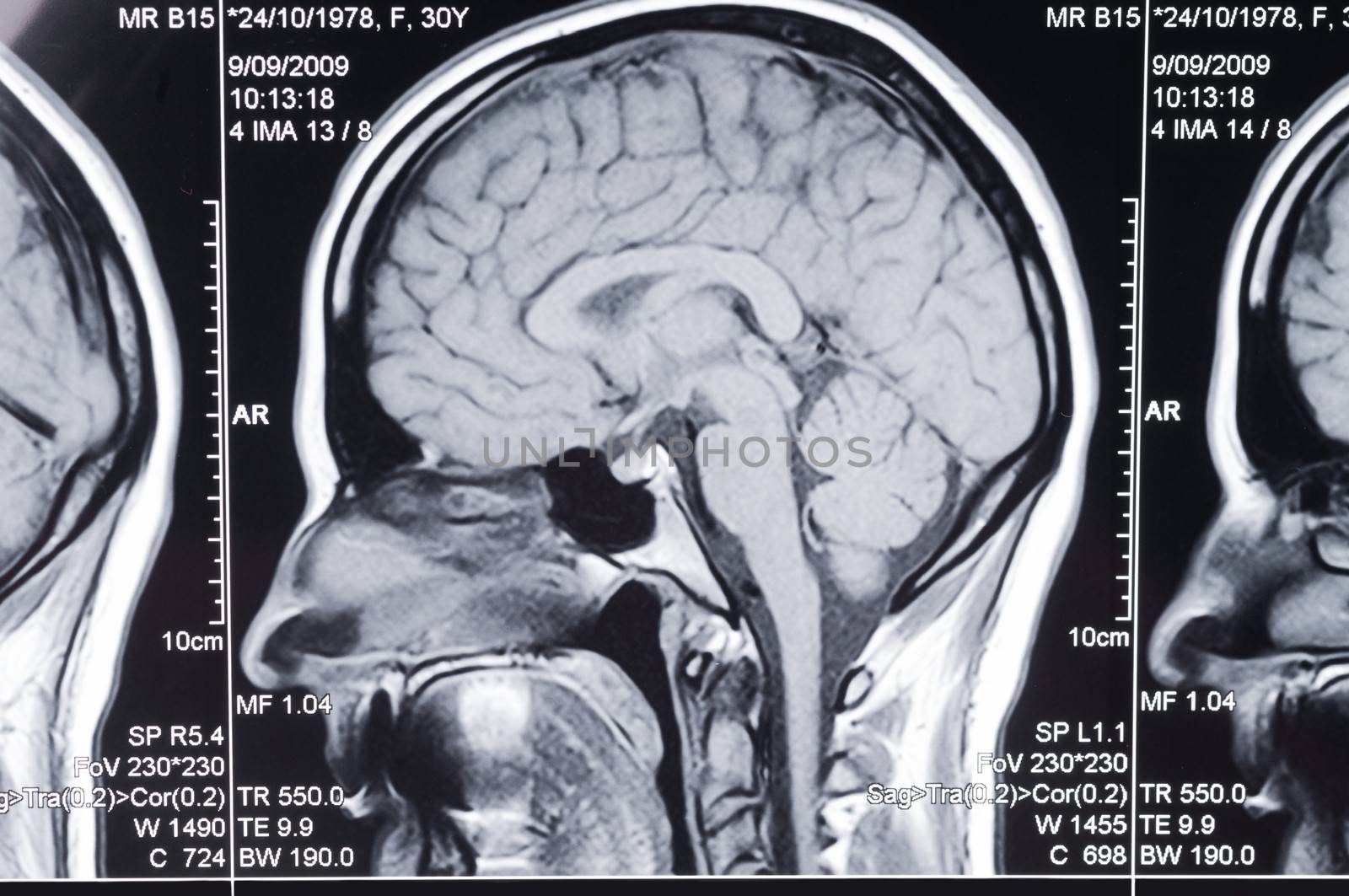 Closeup of a computer axial tomography scan (CAT scan) of a head