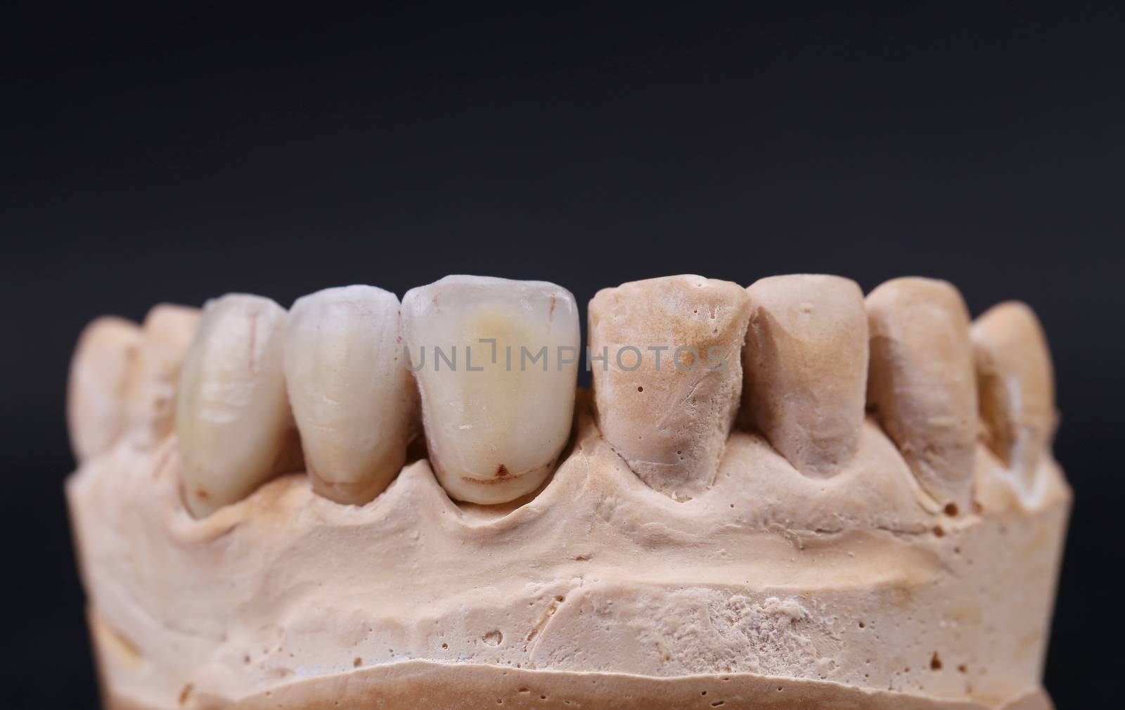 Close up of dental prothetic jaw. by indigolotos