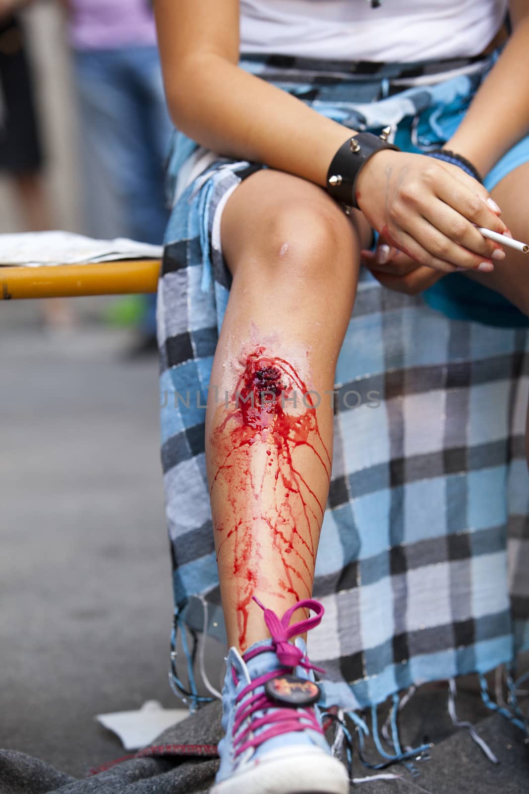 Serious injury on girl's leg