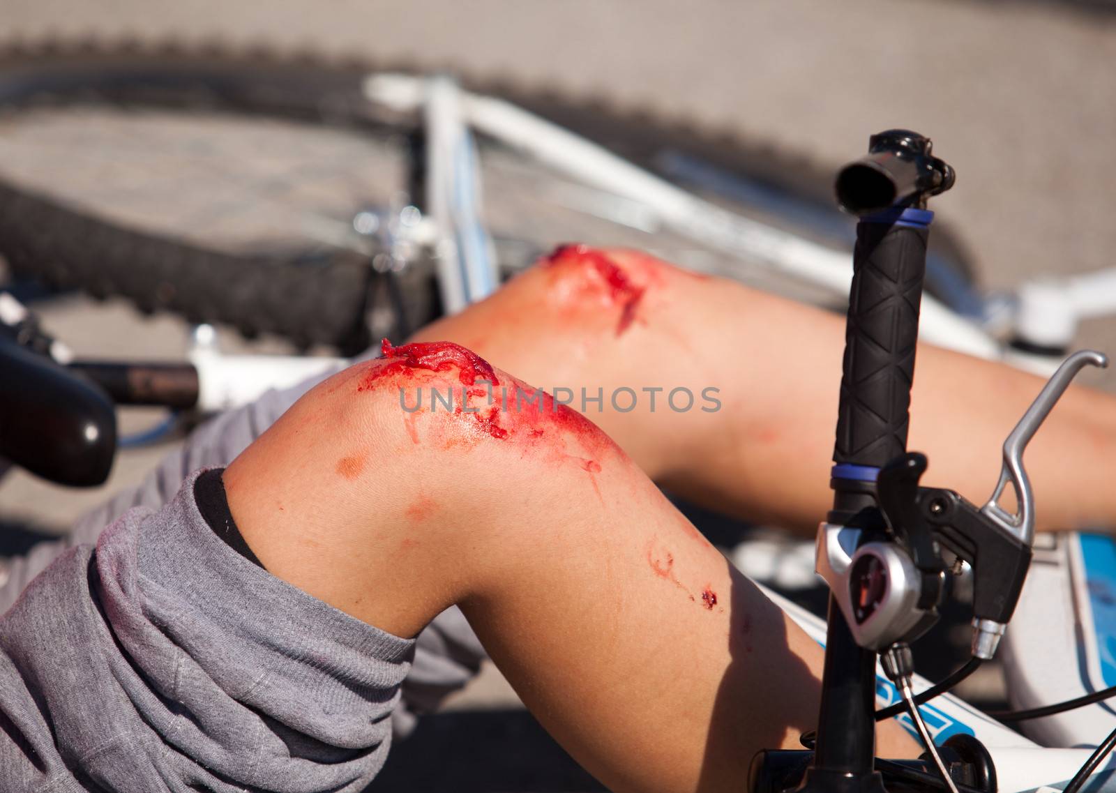 Bike injuries by wellphoto