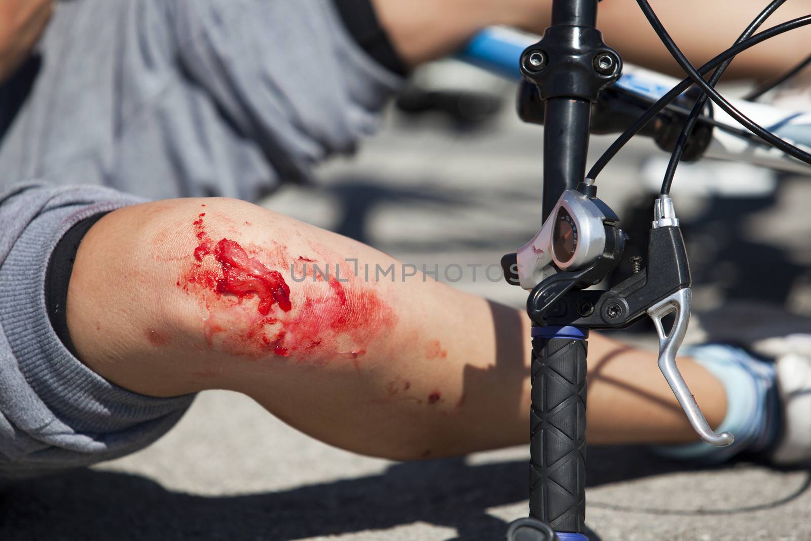 Bike fall injuries by wellphoto