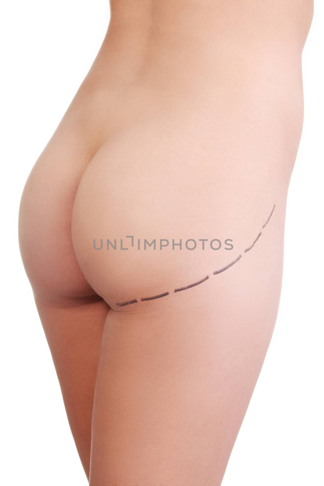 Woman's buttock prepared to plastic surgery , isolated on white