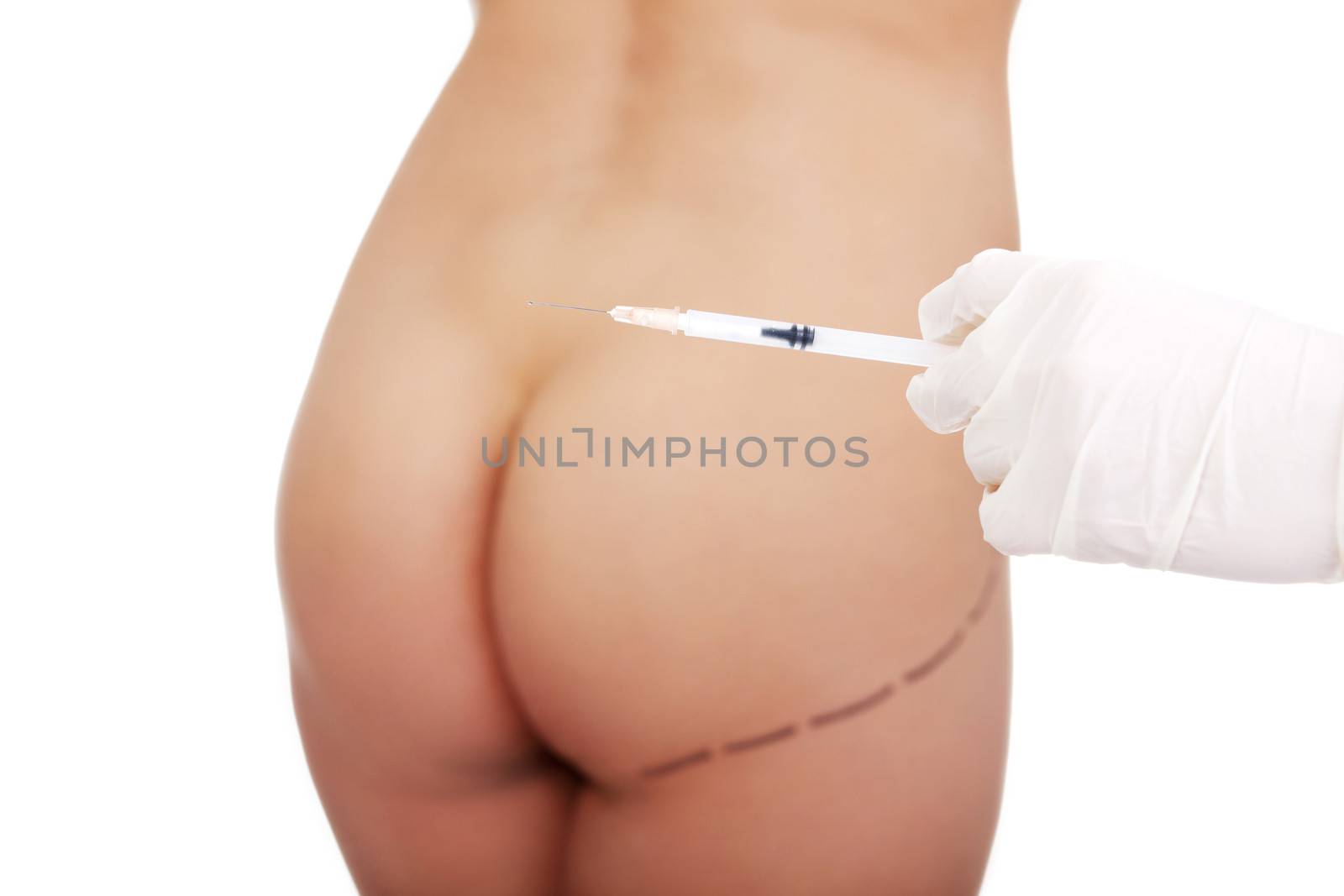 Surgeon hand in glove holding syringe, against buttocks with cosmetic surgery lines
