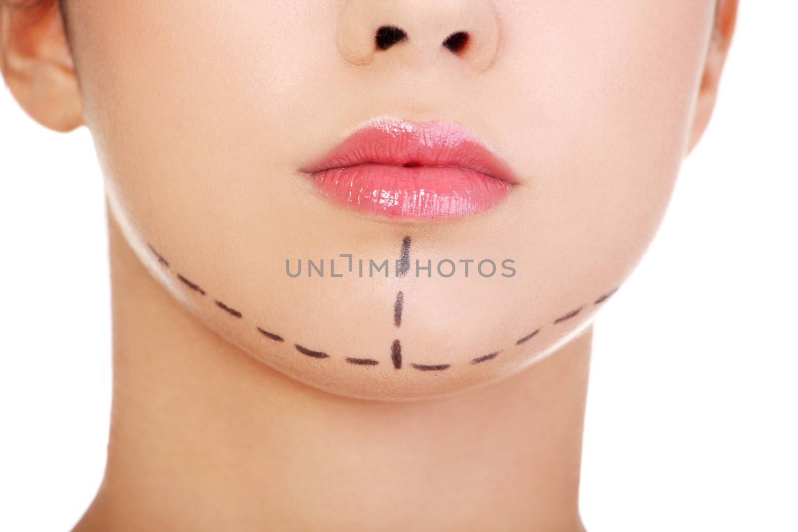 Woman marked out for cosmetic surgery. by BDS