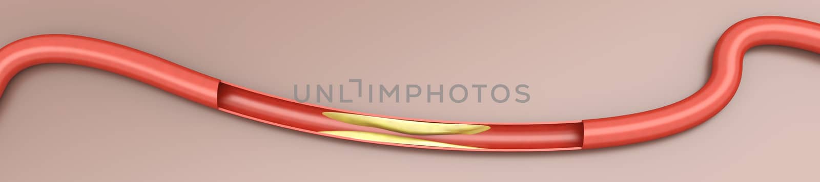 Arteriosclerosis. Plaques tightening an artery. 3D rendered Illustration.  