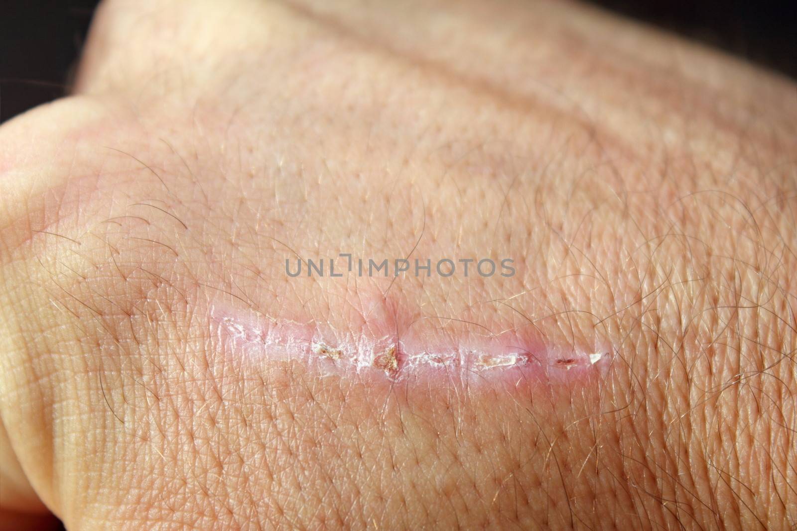 wound healing scar on man's hand