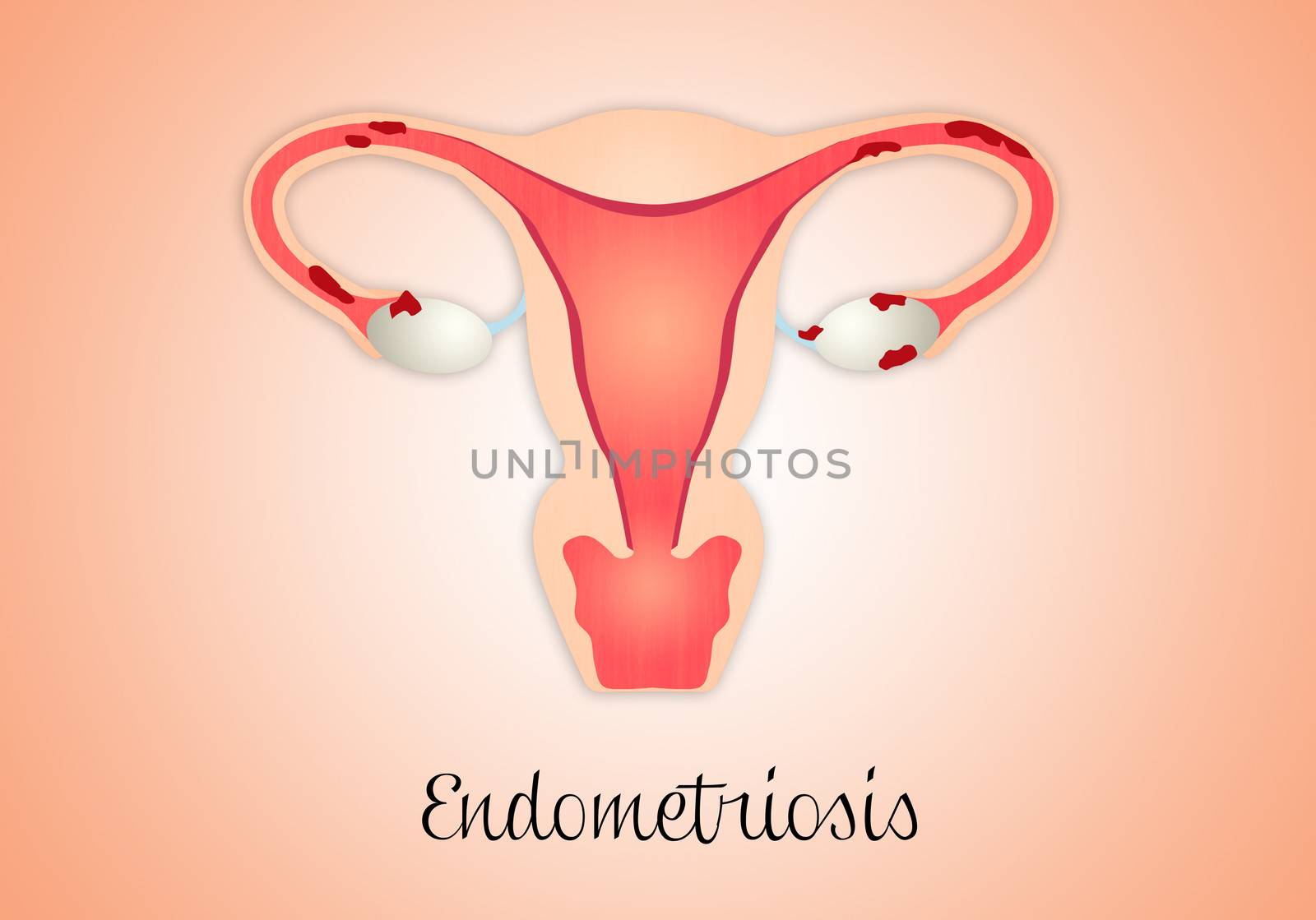 Uterus with endometriosis by sognolucido