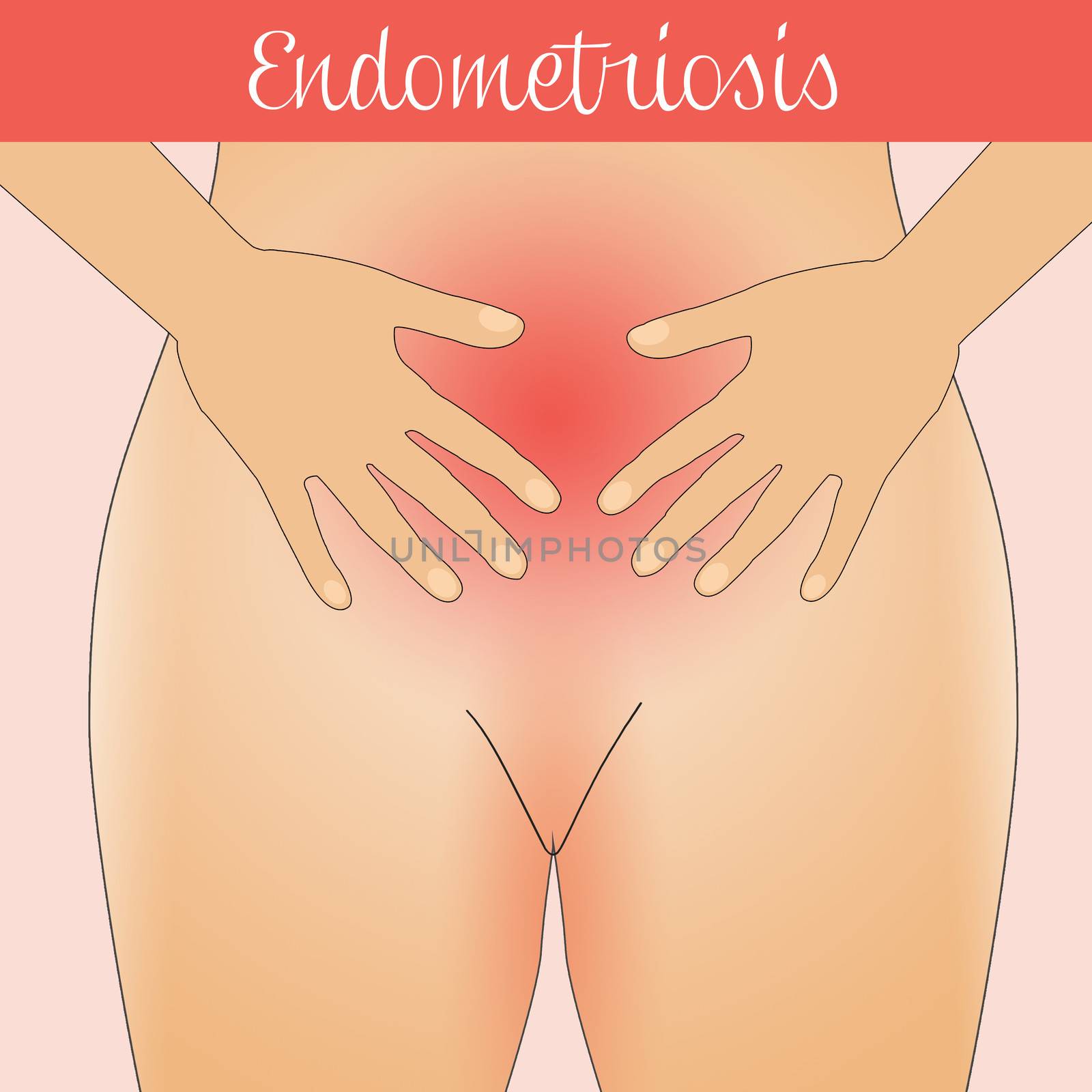 illustration of Endometriosis in woman