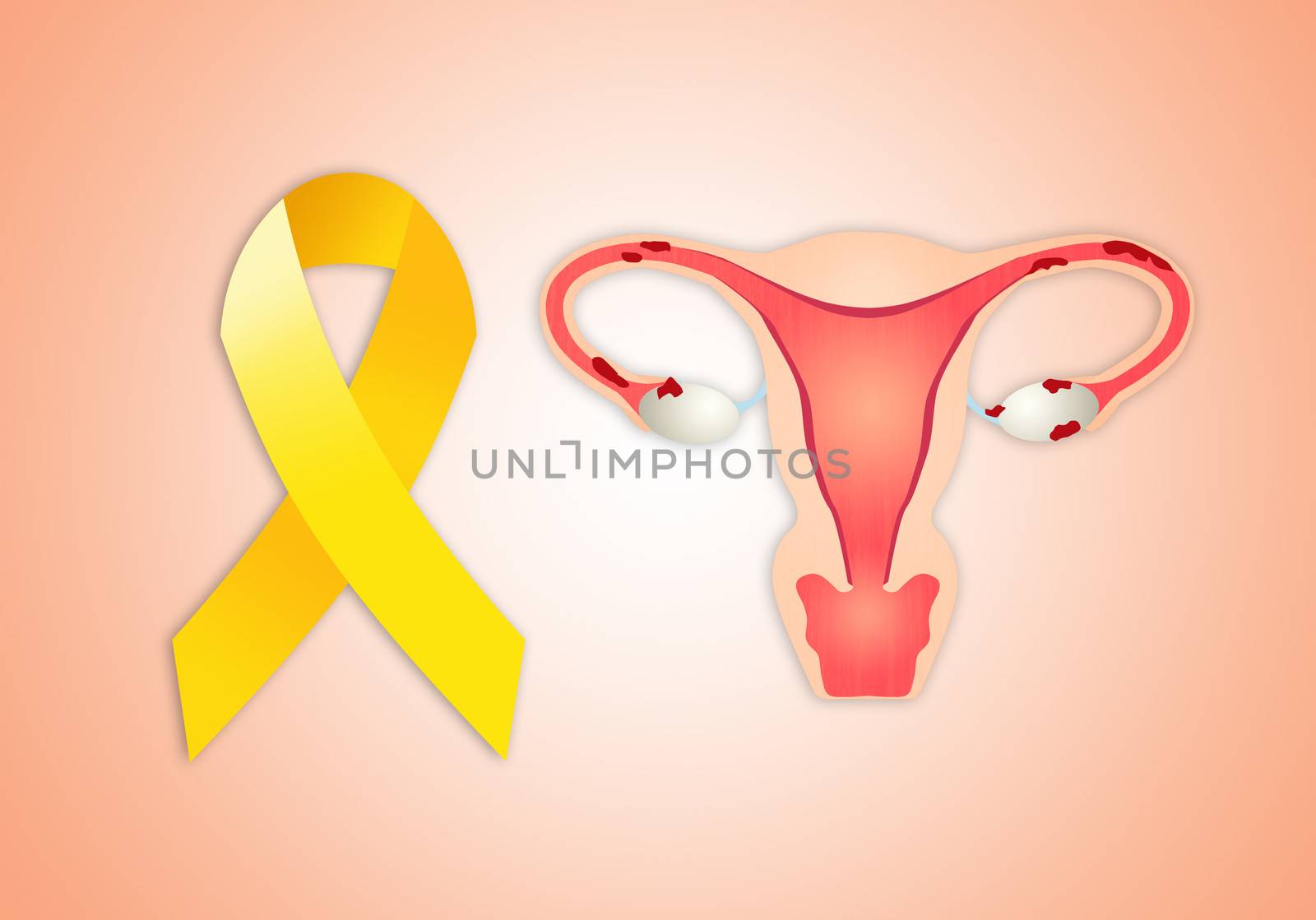 uterus with endometriosis with yellow ribbon by sognolucido