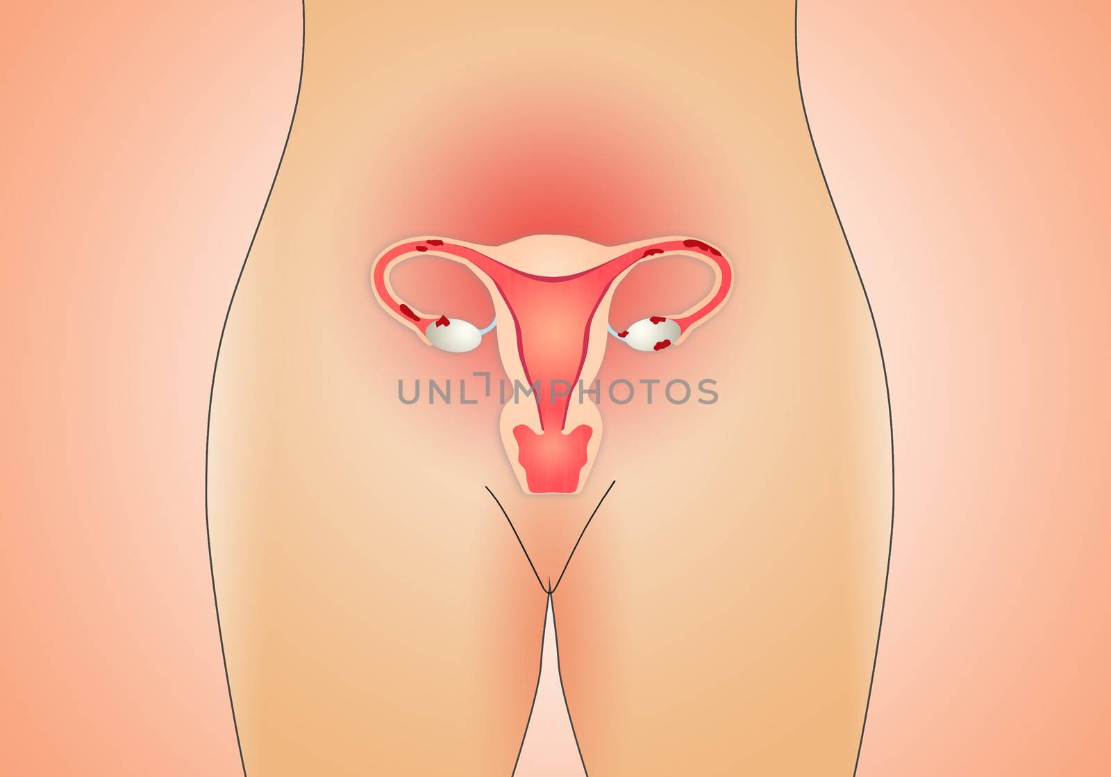 endometriosis in uterus by sognolucido
