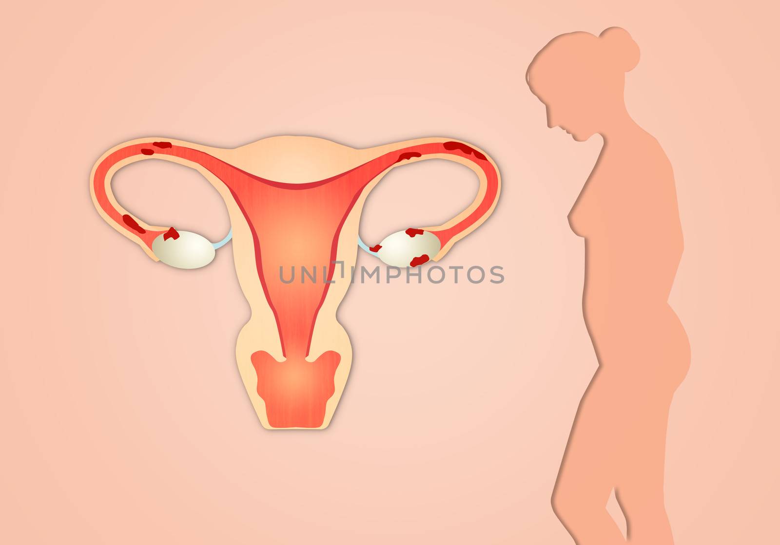 Endometriosis with woman silhouette on pink background