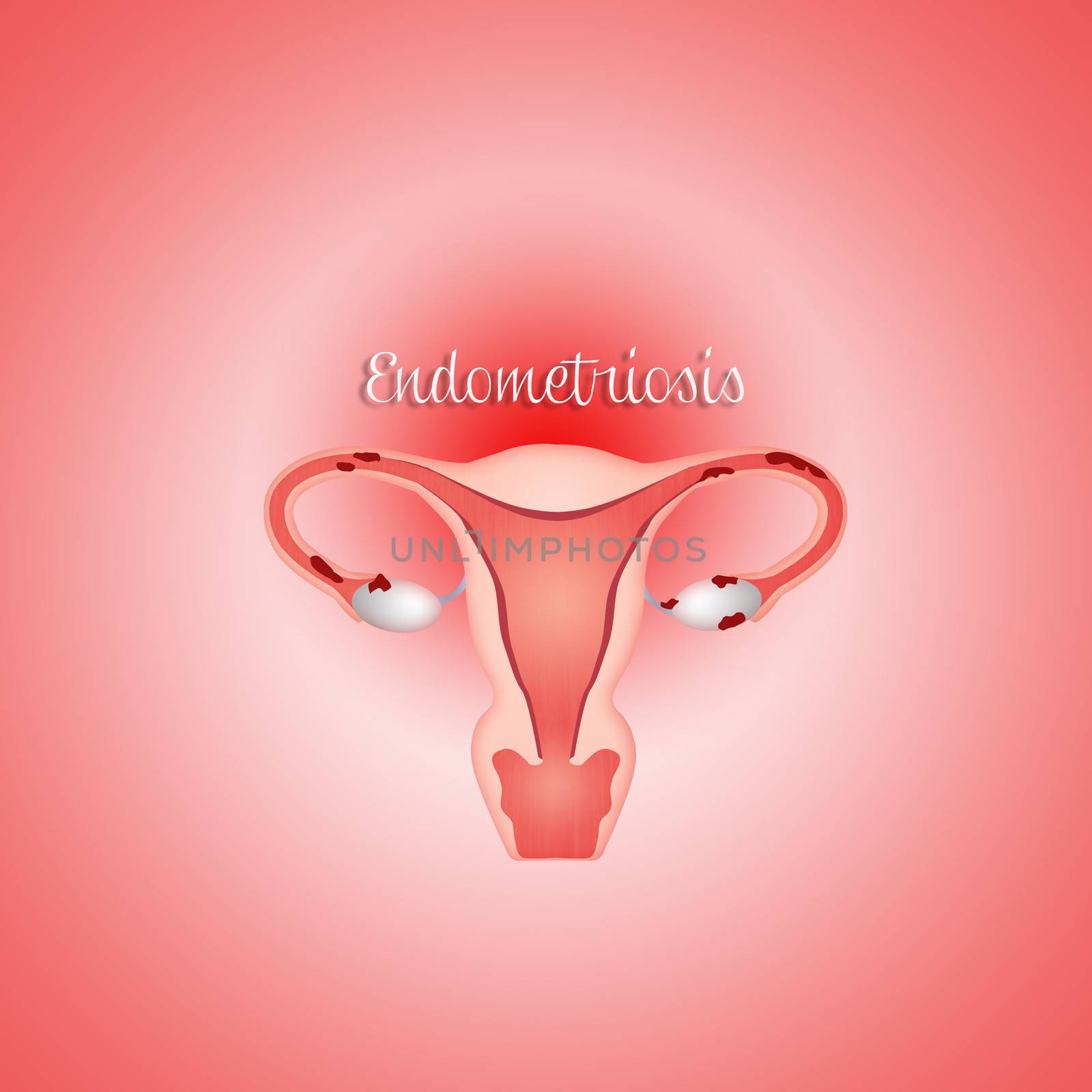 uterus with endometriosis by sognolucido