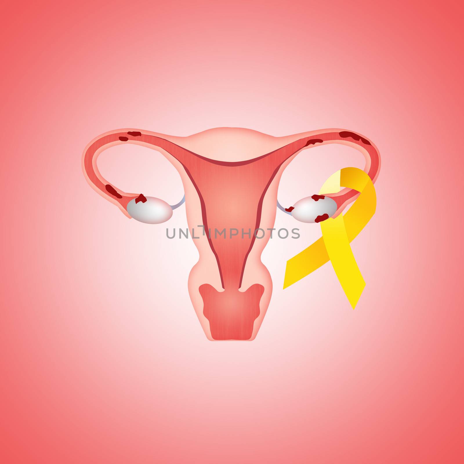 uterus with endometriosis and yellow ribbon by sognolucido