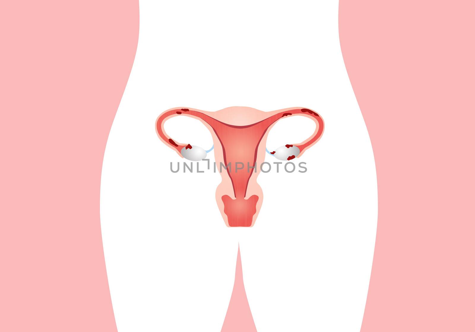 uterus with endometriosis by sognolucido