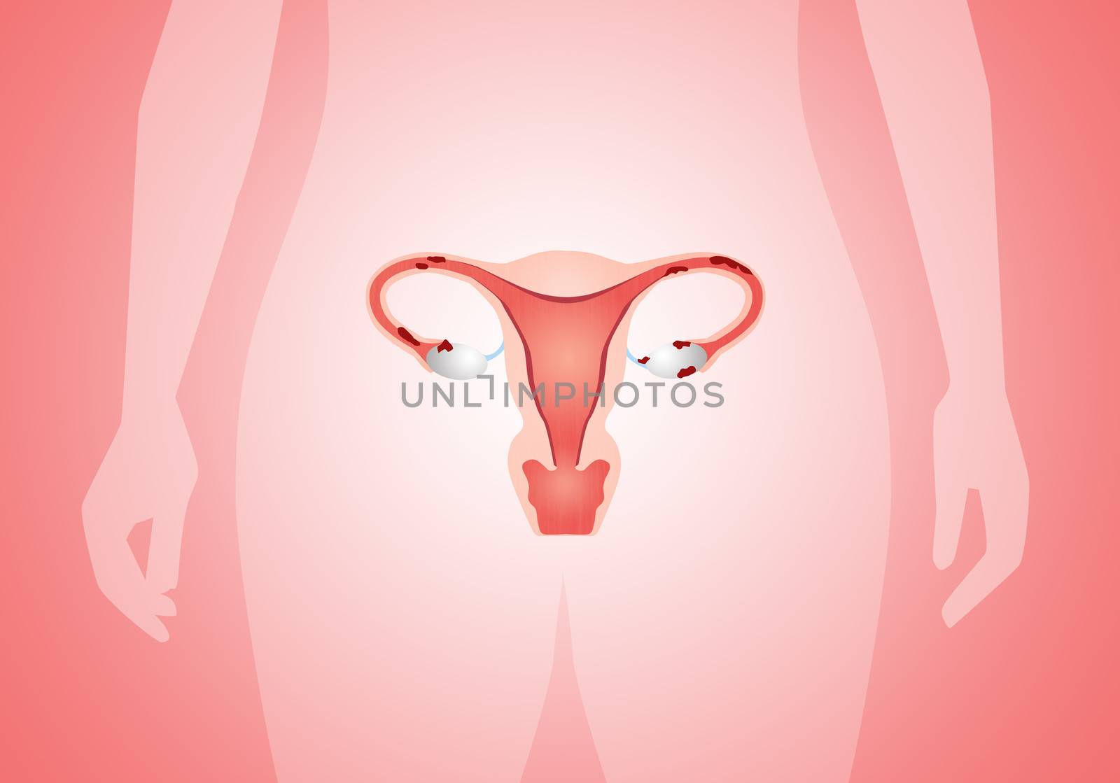 uterus with endometriosis by sognolucido