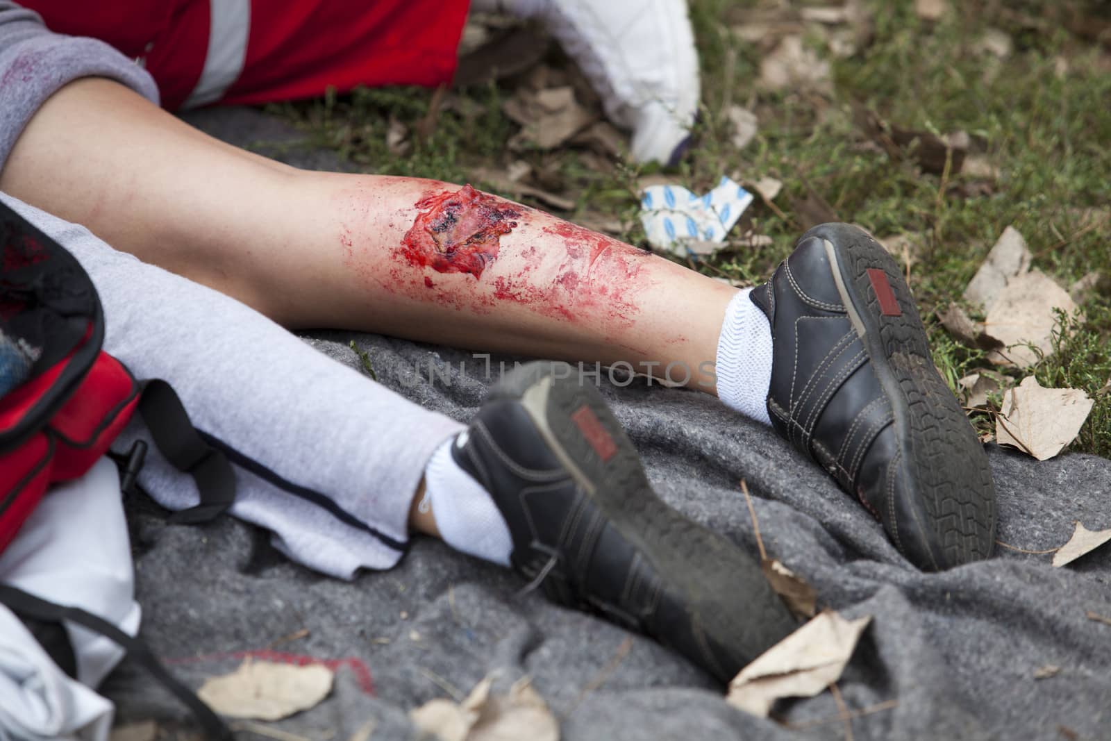 Serious injury on girl's leg