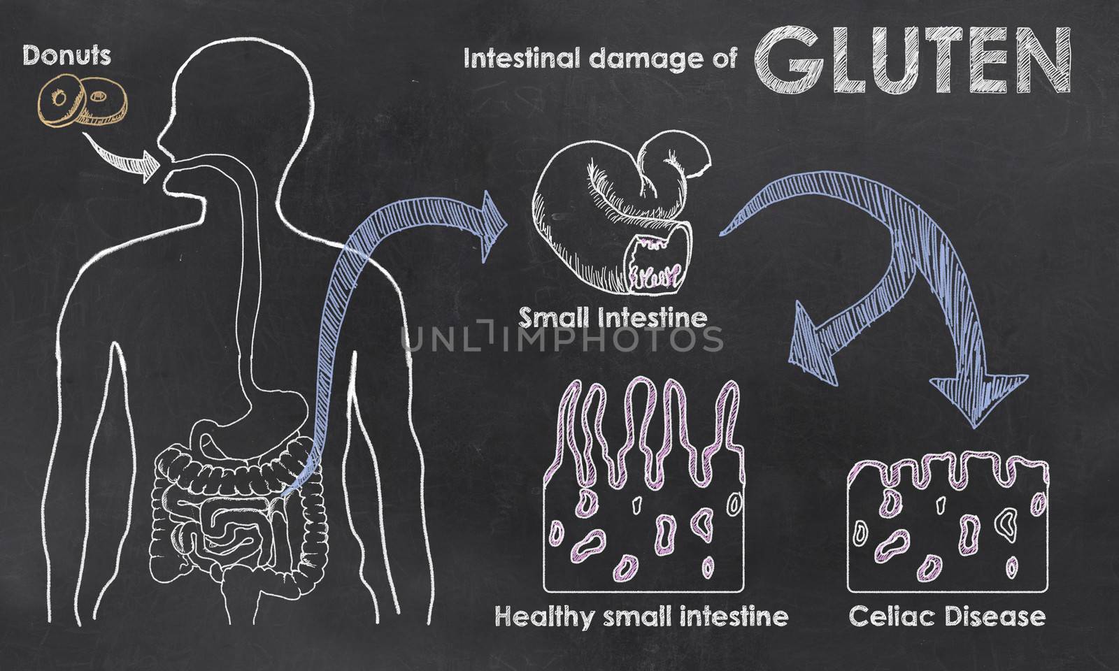 Intestinal Damage of Gluten on a Blackboard