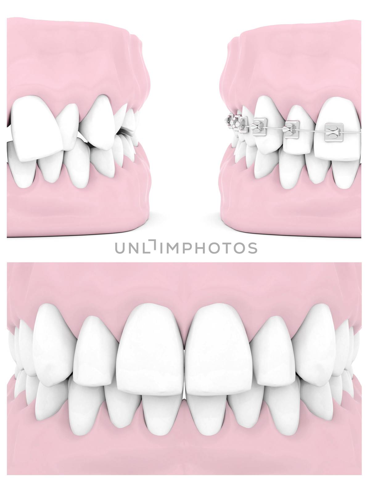 Dental braces isolated on white background