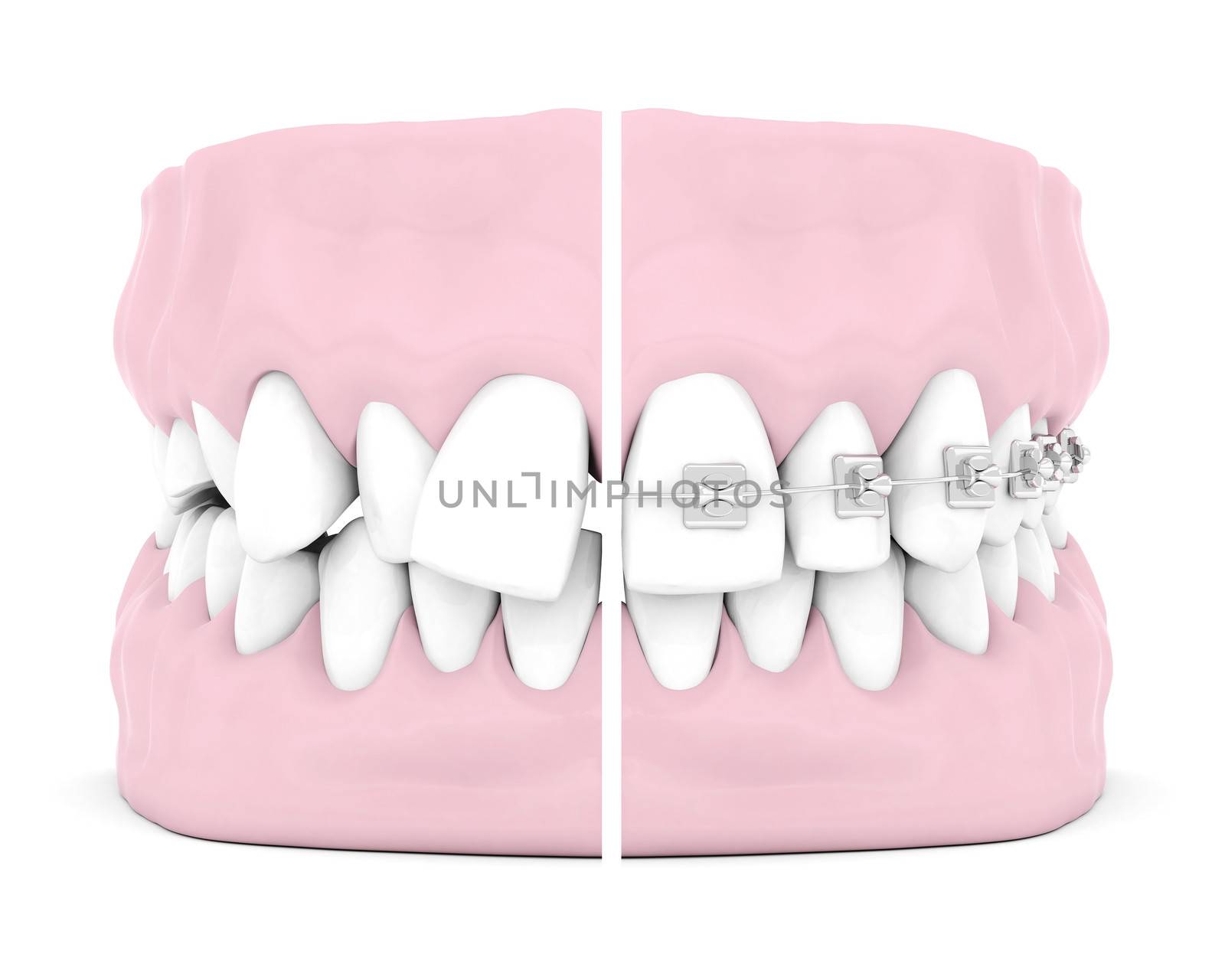Dental braces by mrgarry