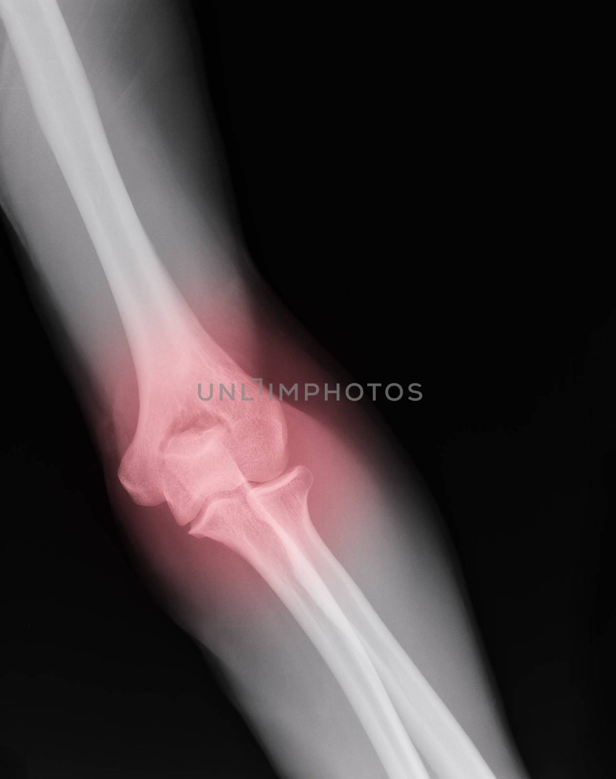 xray of an arm with elbow joint visible and red pain circle