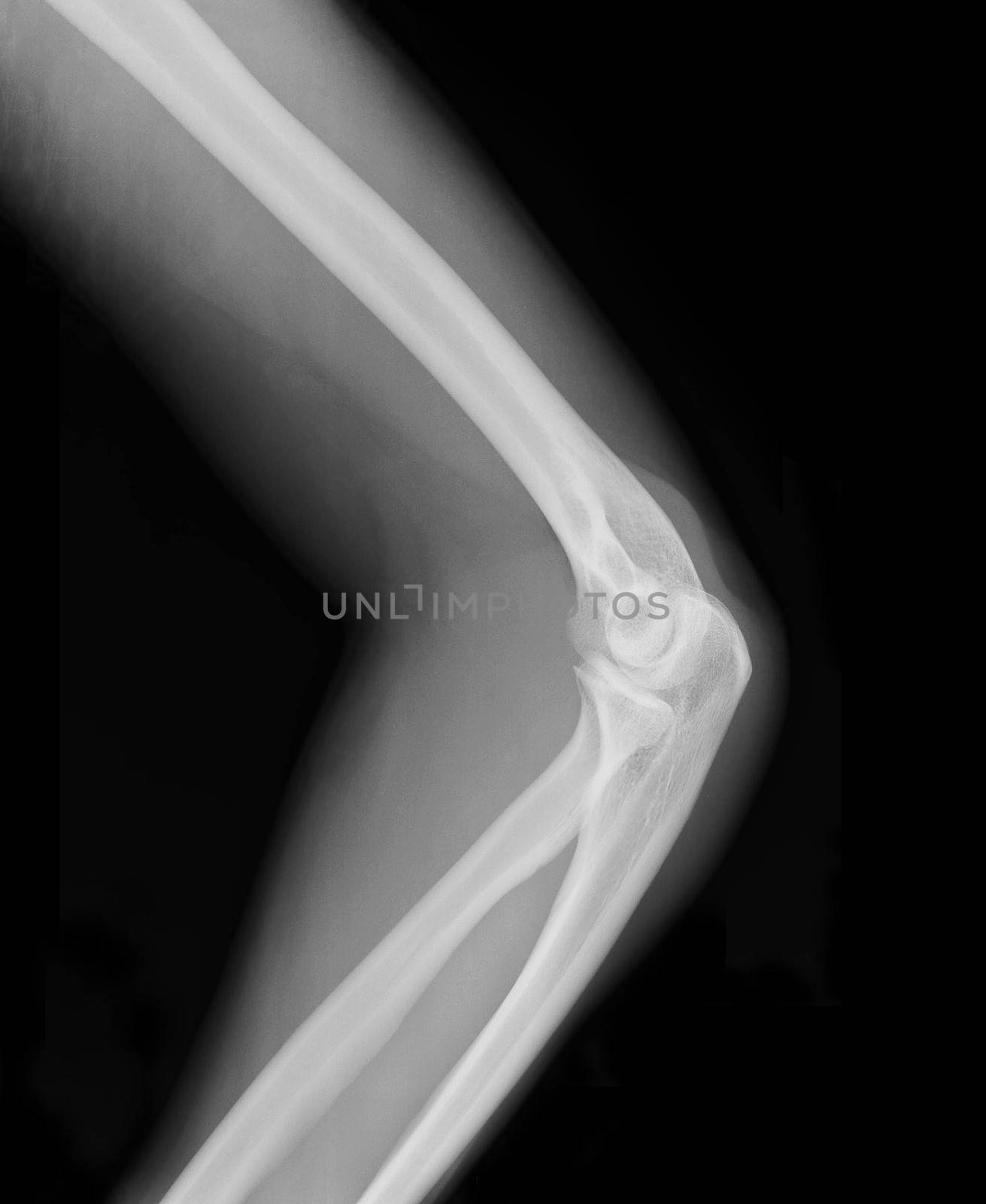 xray of an arm with elbow joint visible