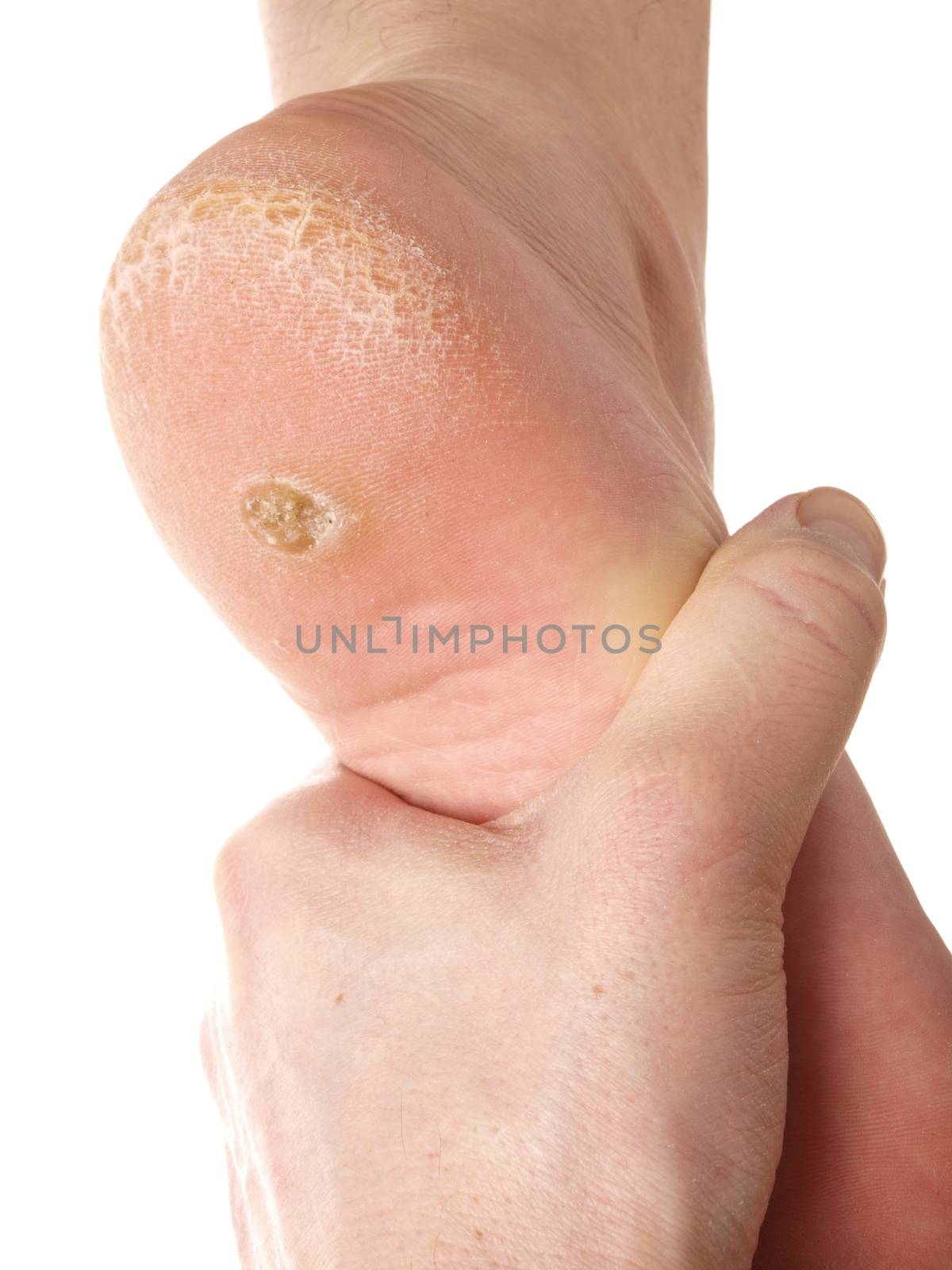 Dermatologist examining a foot for callus and dry skin, towards white