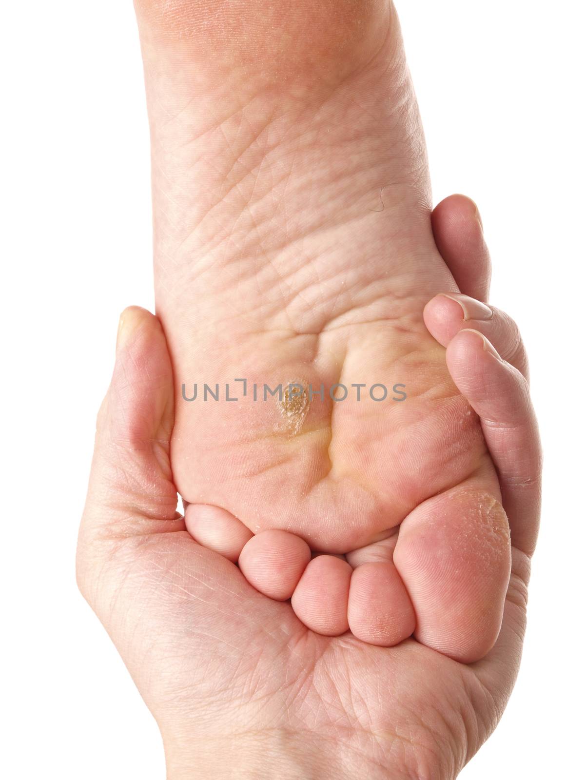 Dry skin under foot by Arvebettum