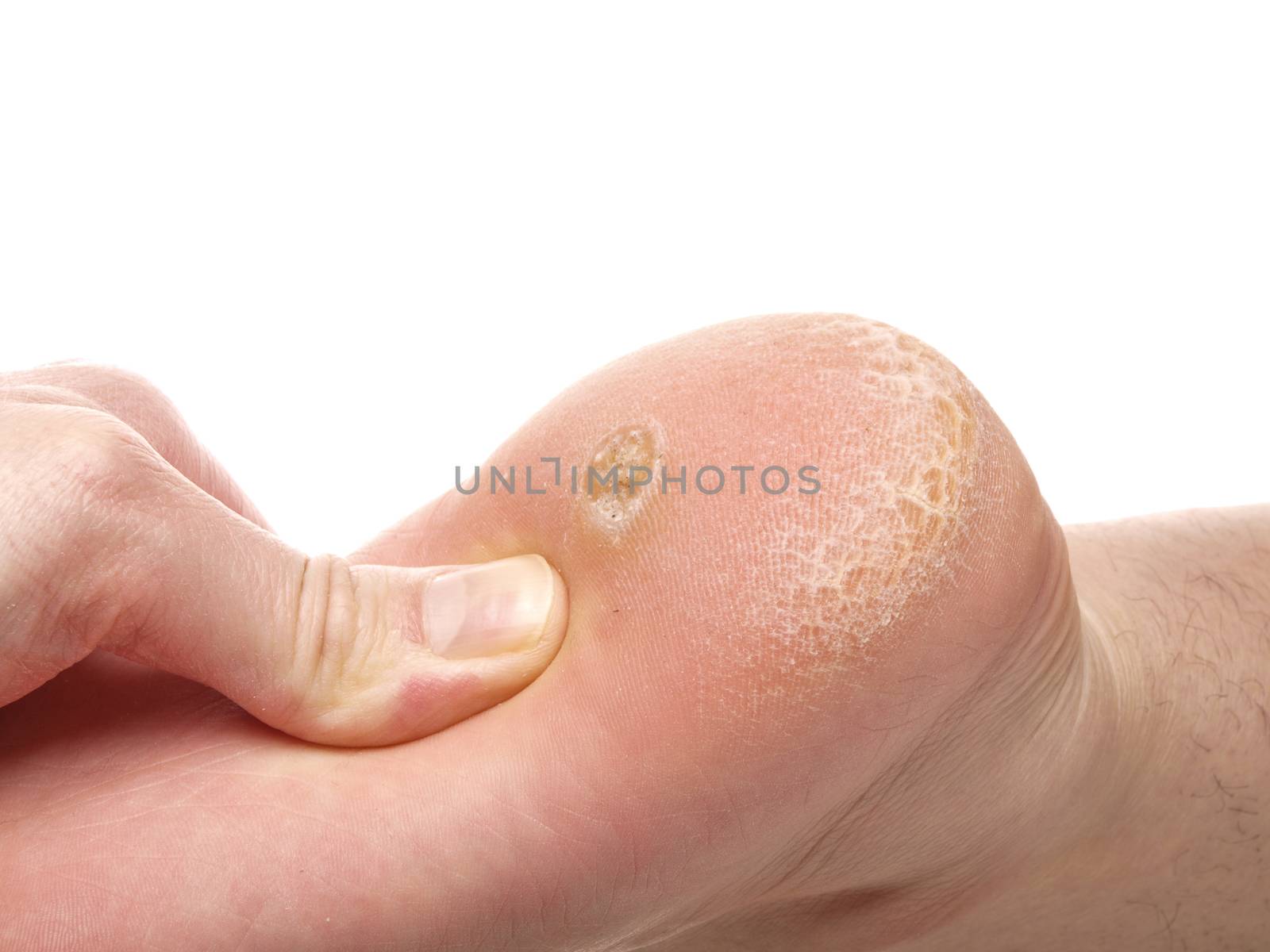 Dry skin and callus under foot by Arvebettum