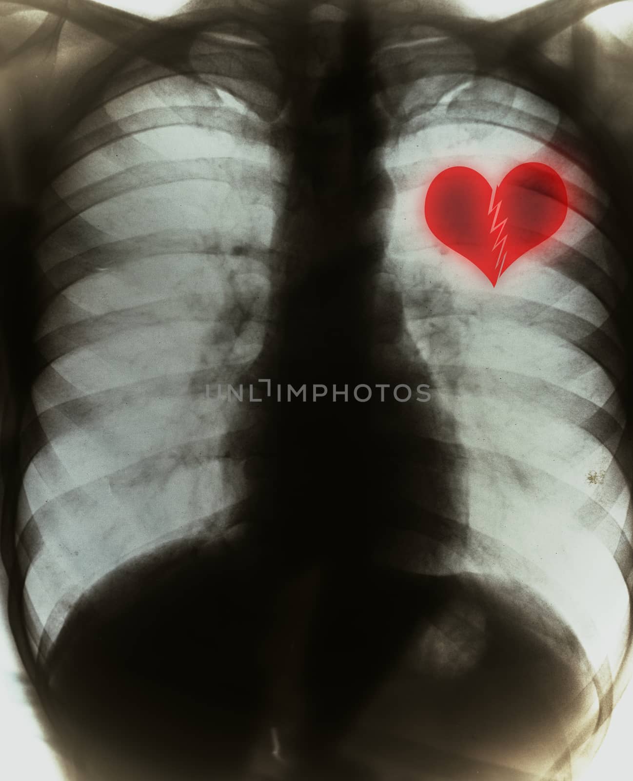 Broken heart on black x-ray film