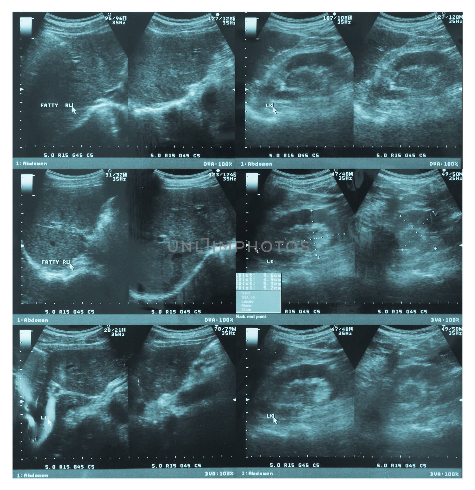 ultrasonography image of abdomen