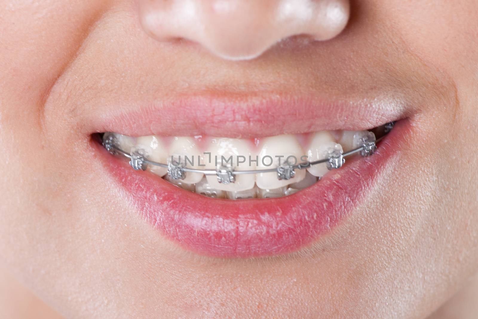 teeth with braces, close up. young woman photo.