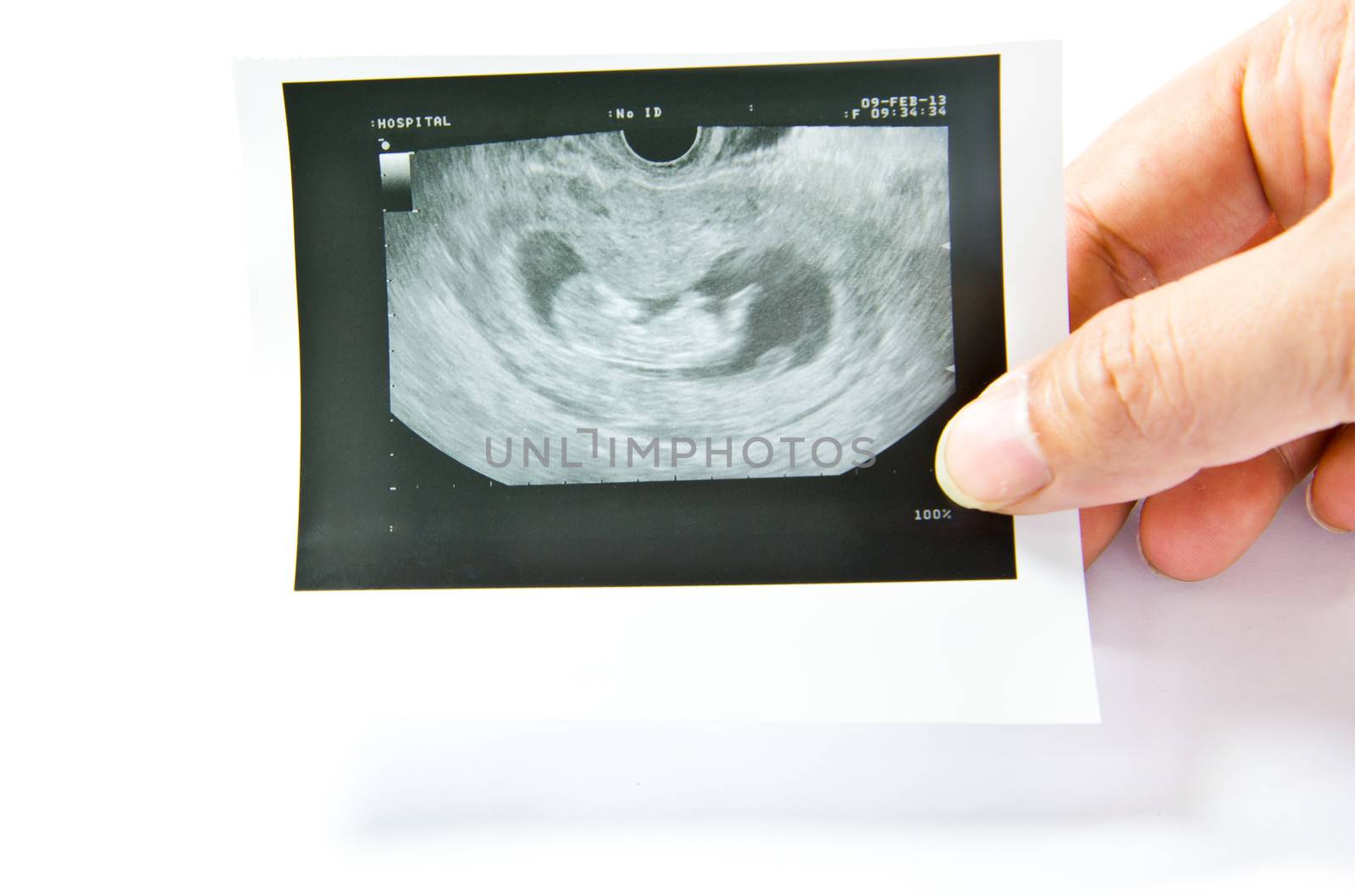 12 weeks baby ultrasound Image  by tisskananat