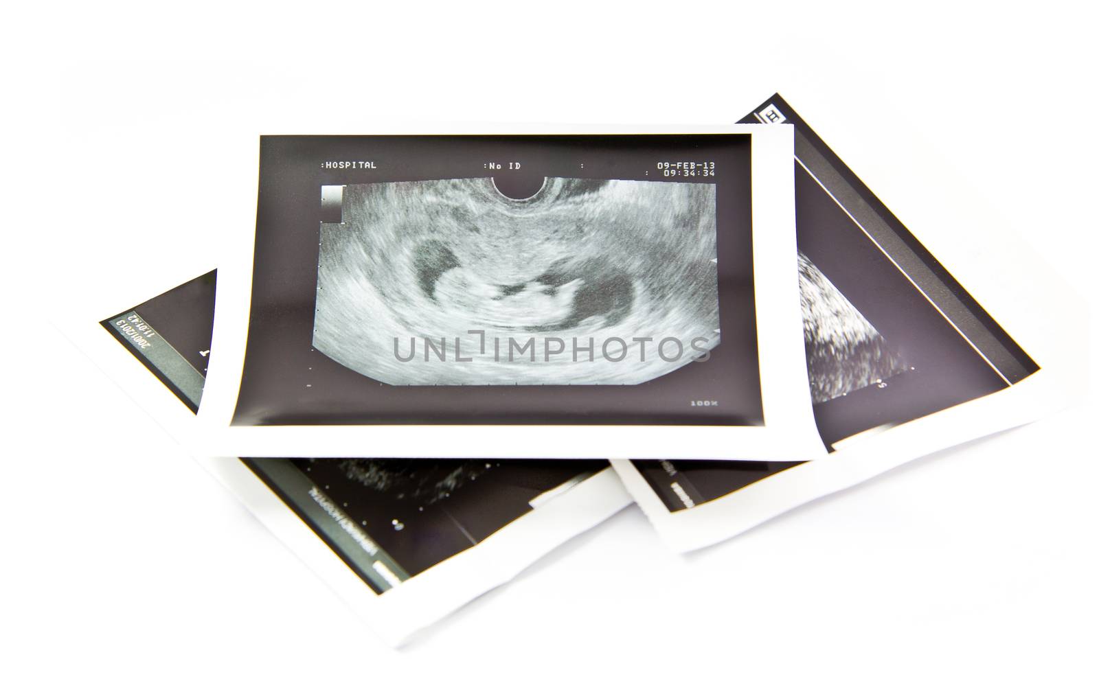 12 weeks baby ultrasound Image  by tisskananat