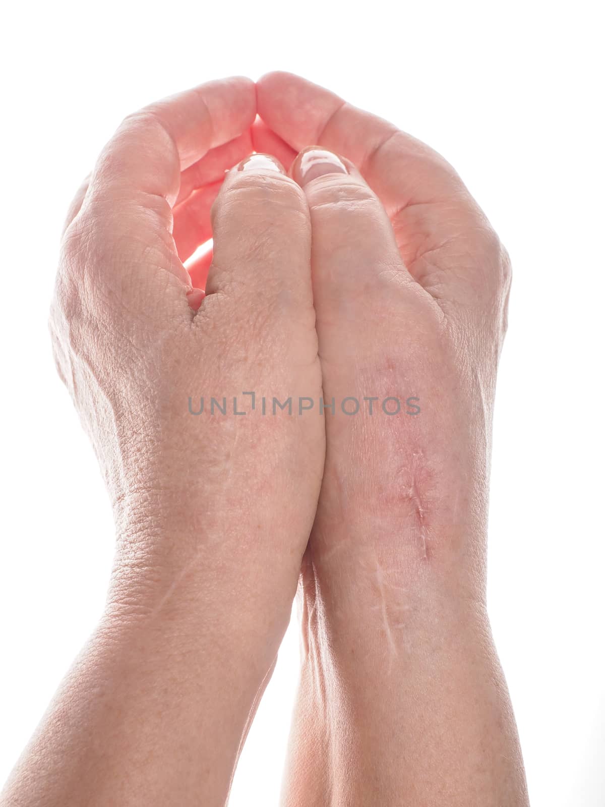 Female person with a pair of hands with scars towards white